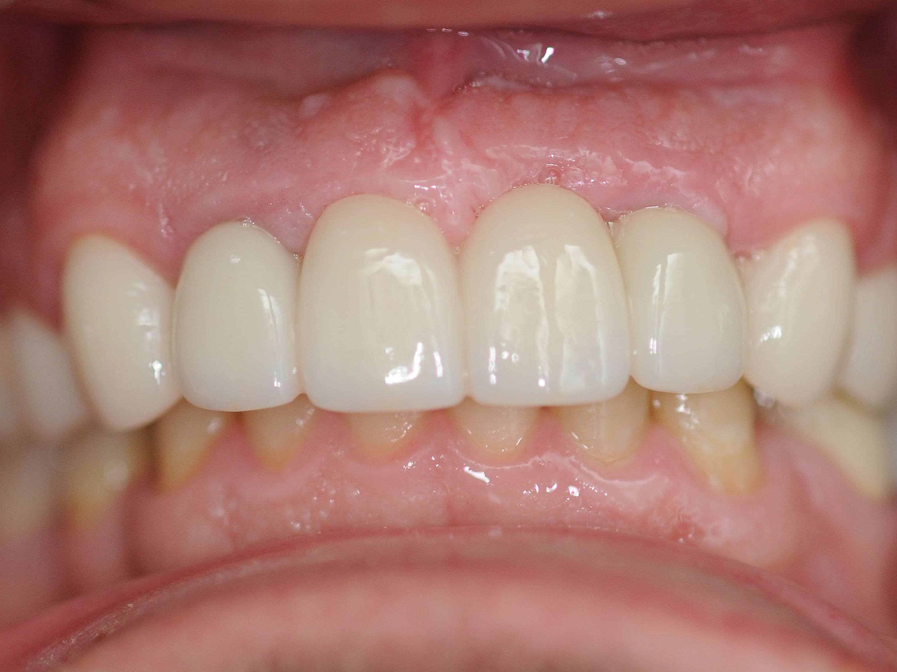 Brand New Smile After