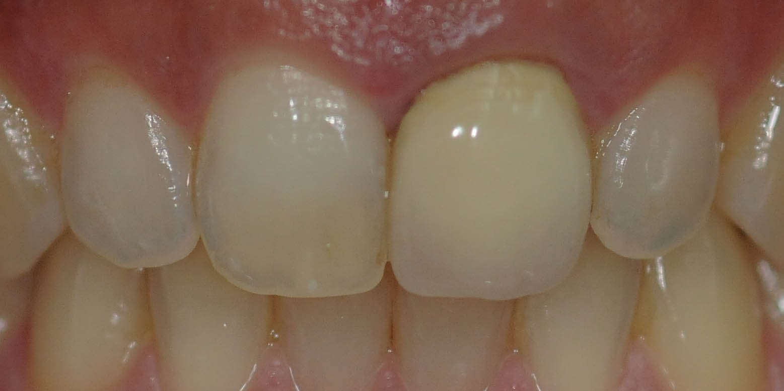 Before and After Before