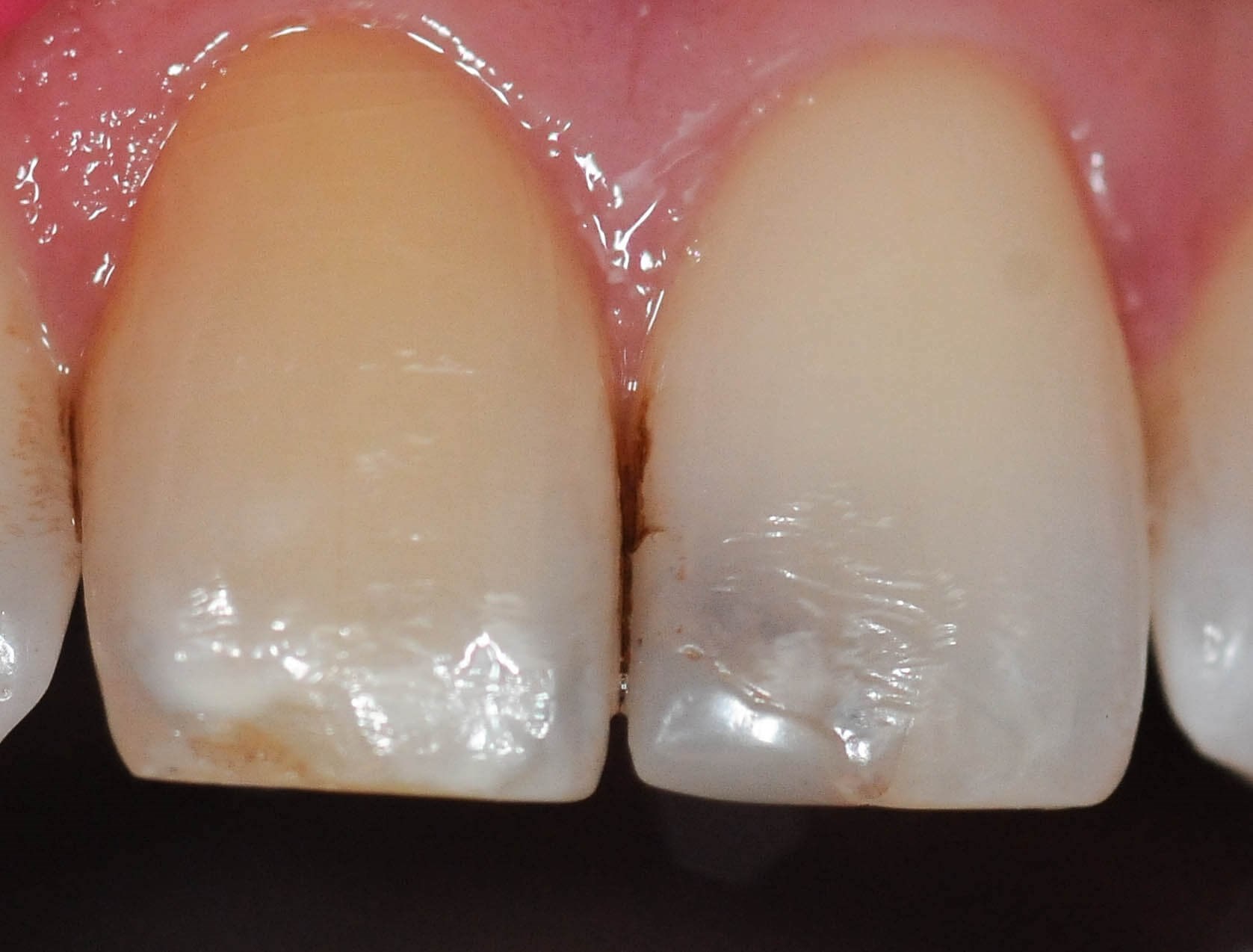 Replacing Composite Filling Before