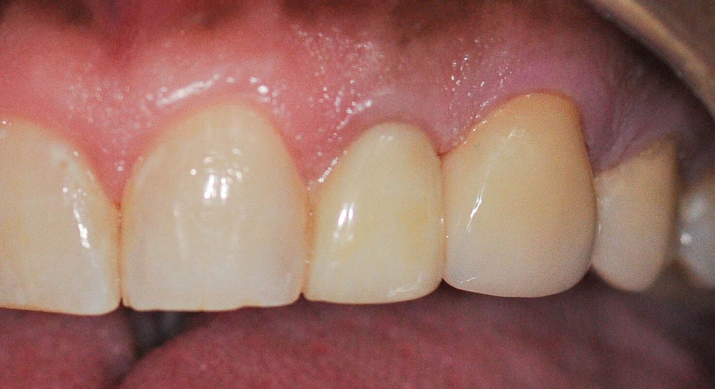 Before and After After