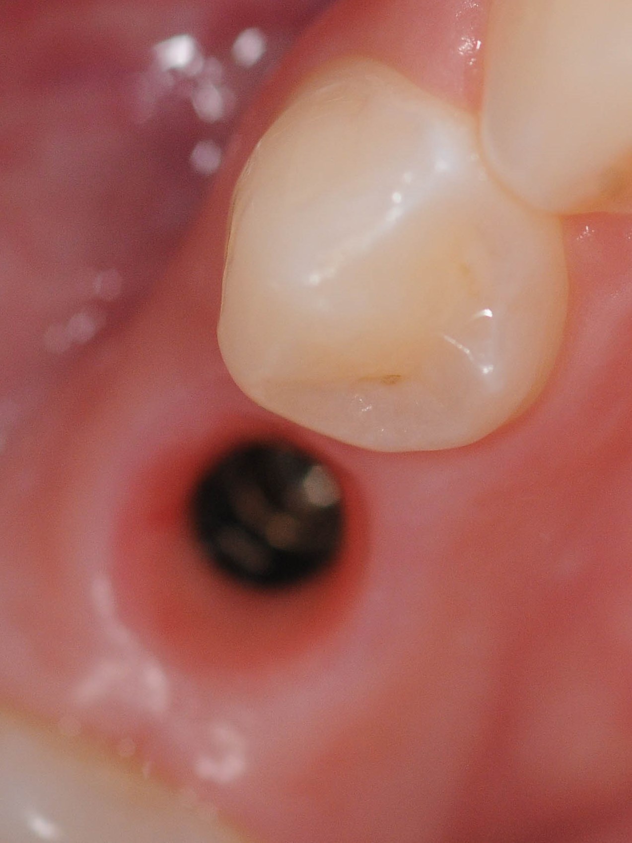 Implant Crown Before