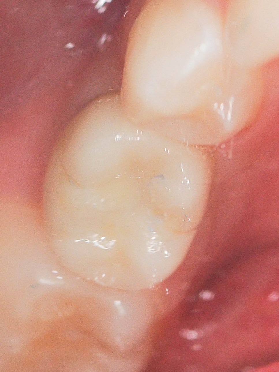 Implant Crown After