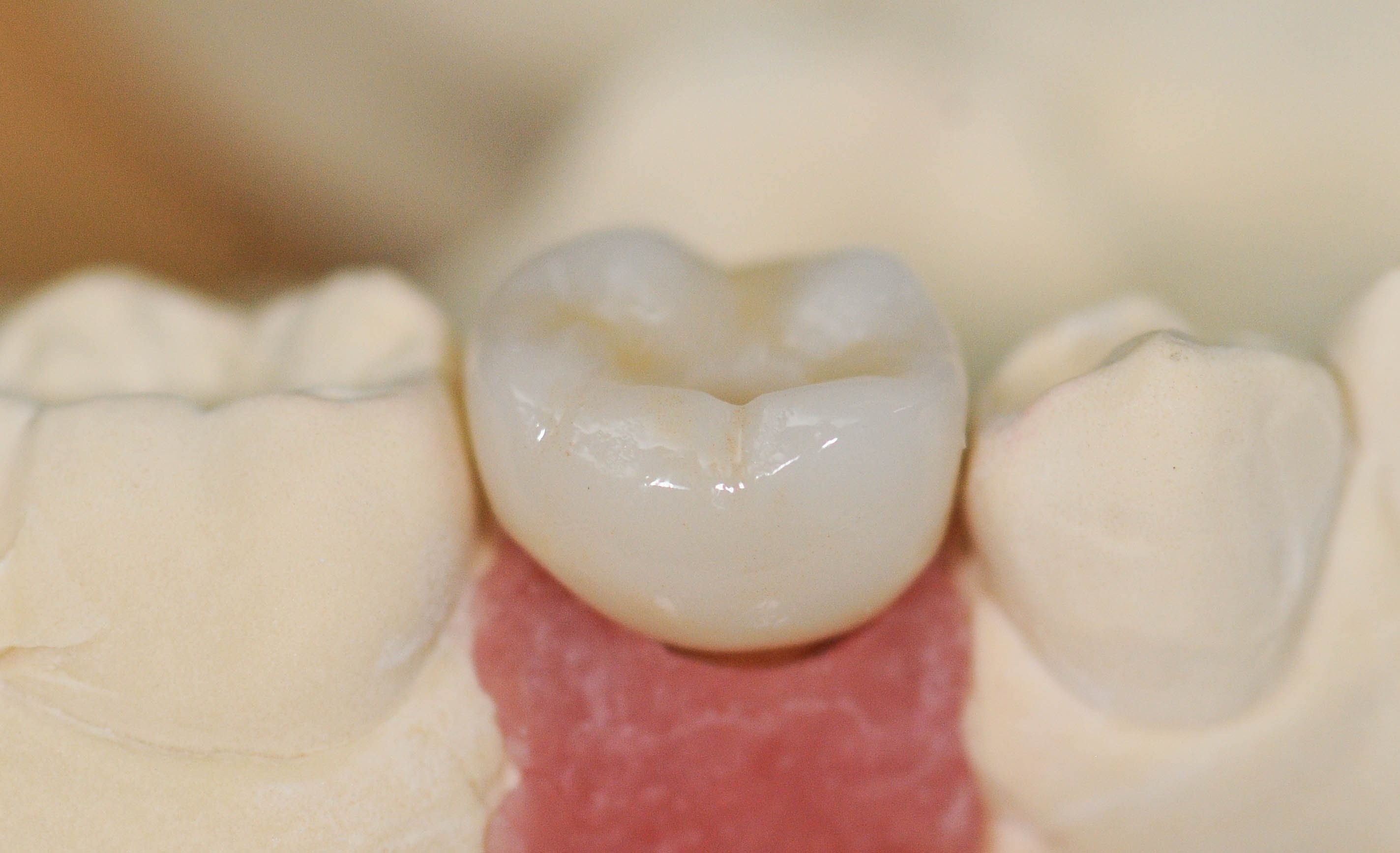 Implant Crown Implant on Model
