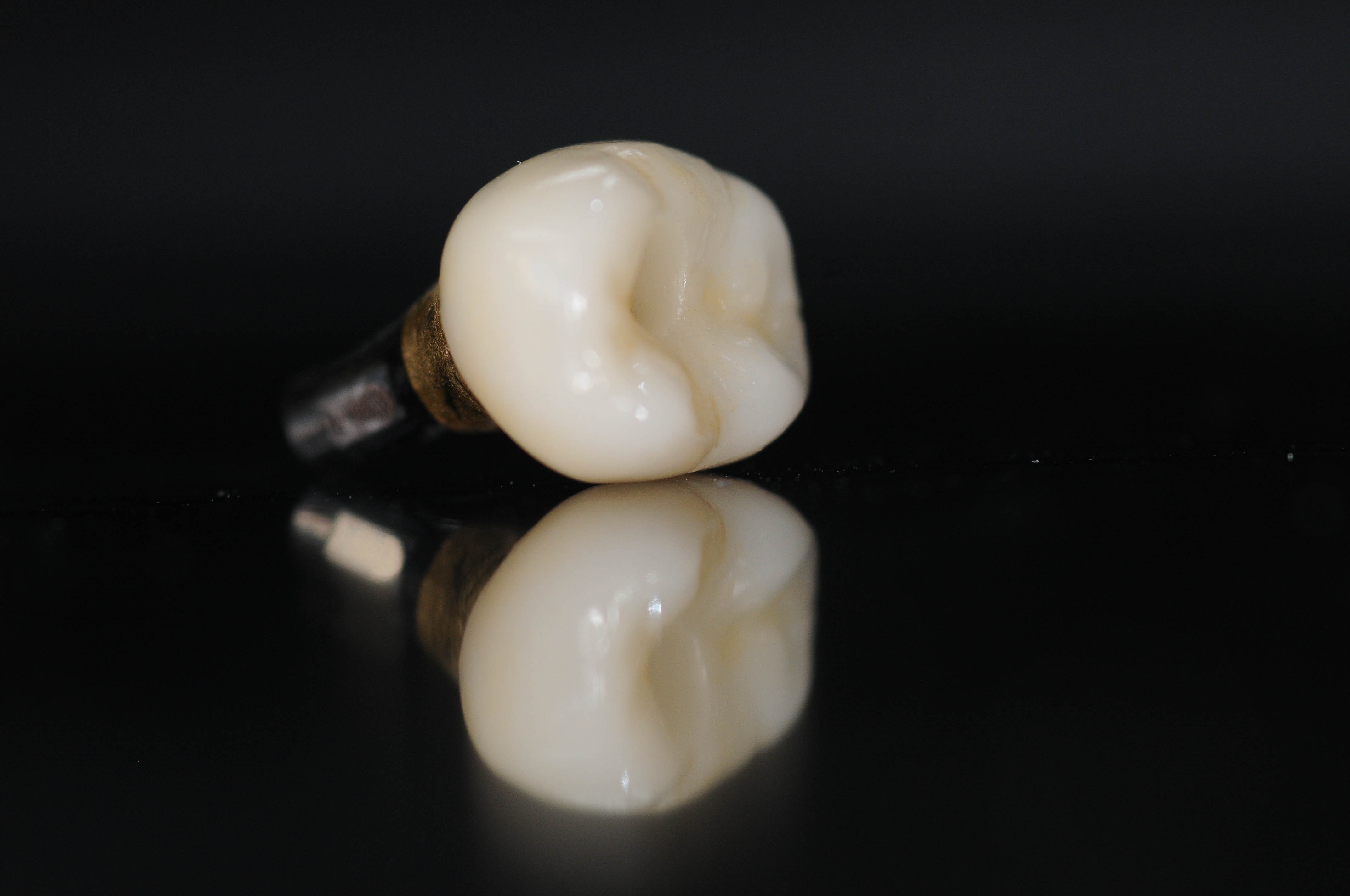 Implant Crown Beautiful Implant Crown