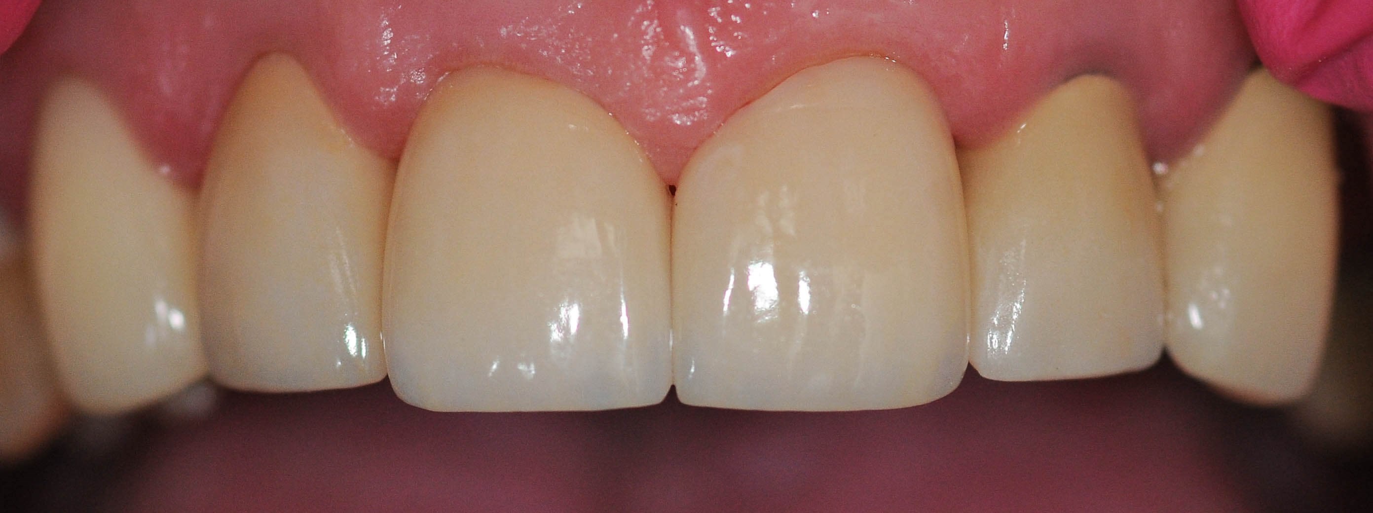 Before and After After