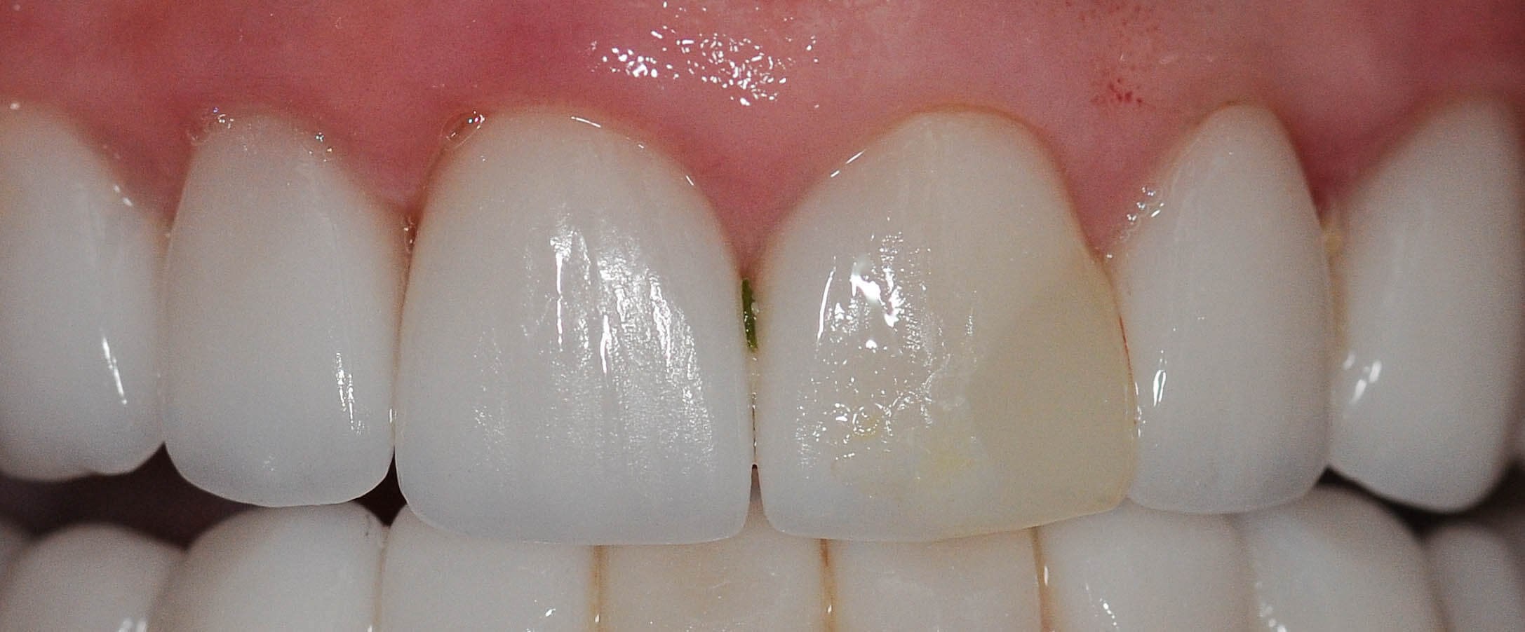 Before and After Before