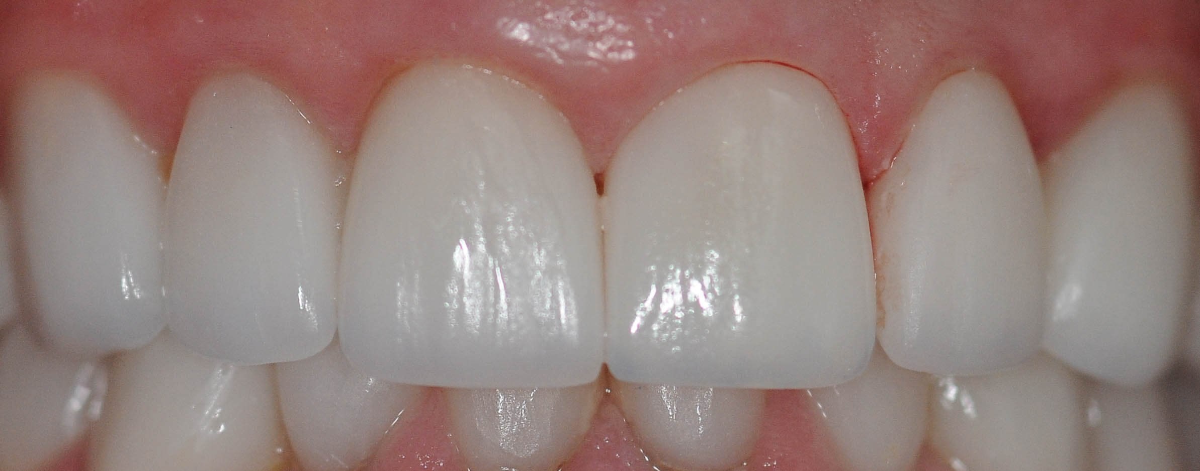 Before and After After