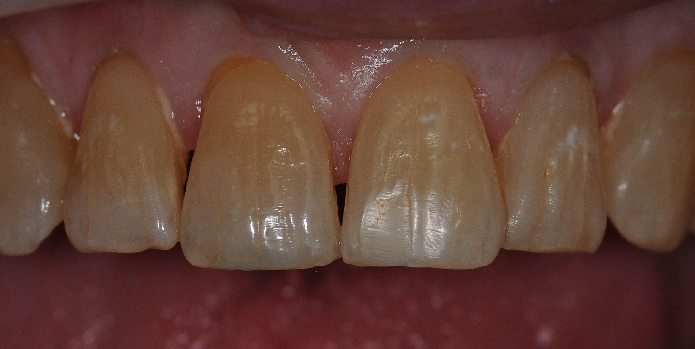 Fixing a Chipped tooth After