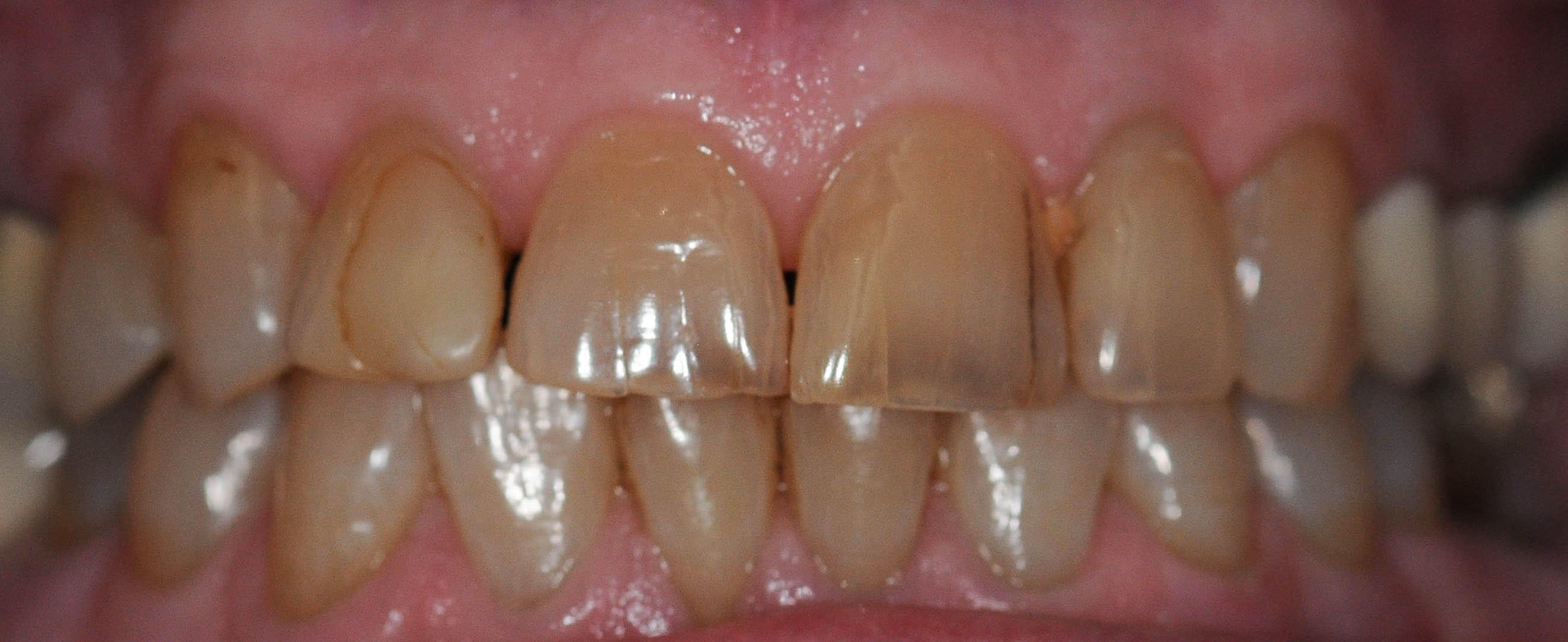 Before and After Whitening Before