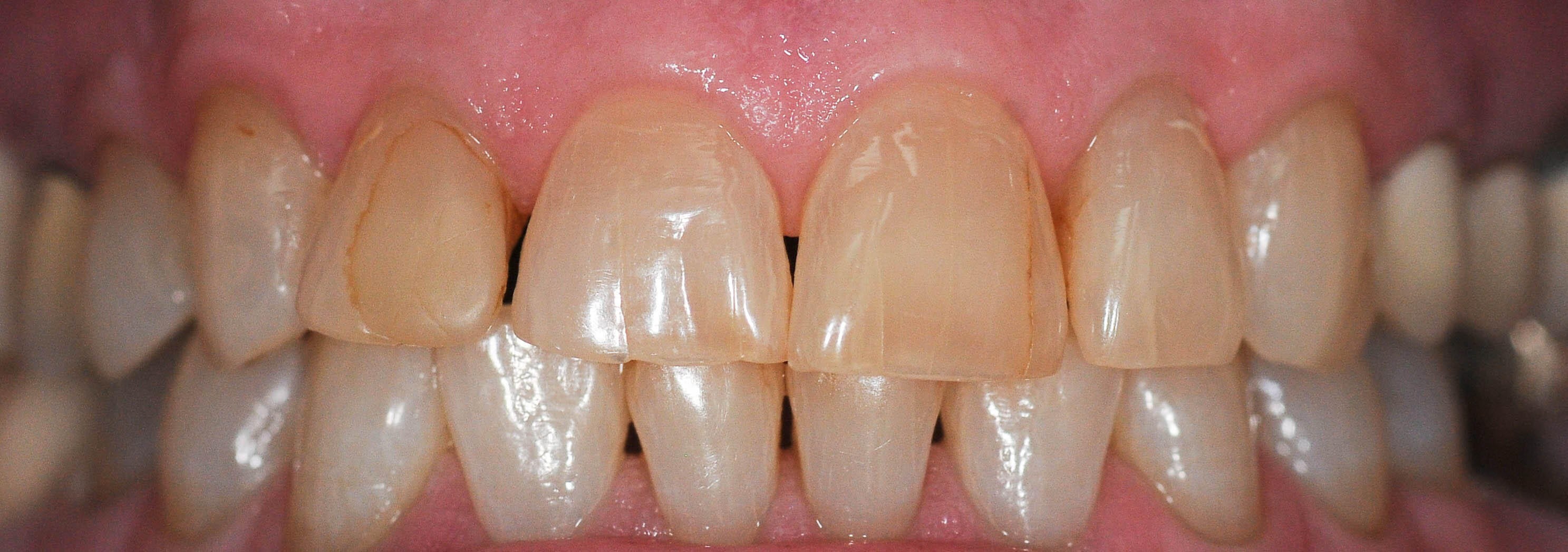 Before and After Crowns Before