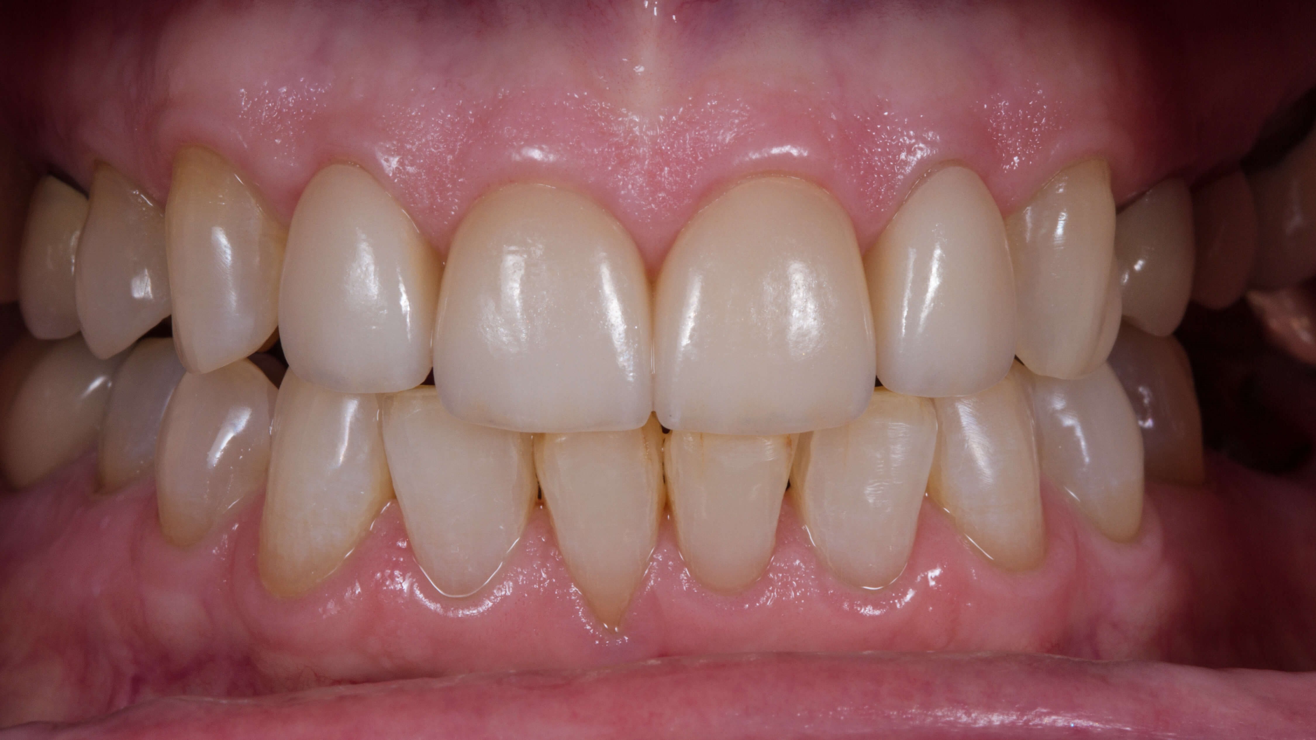 Before and After Crowns After