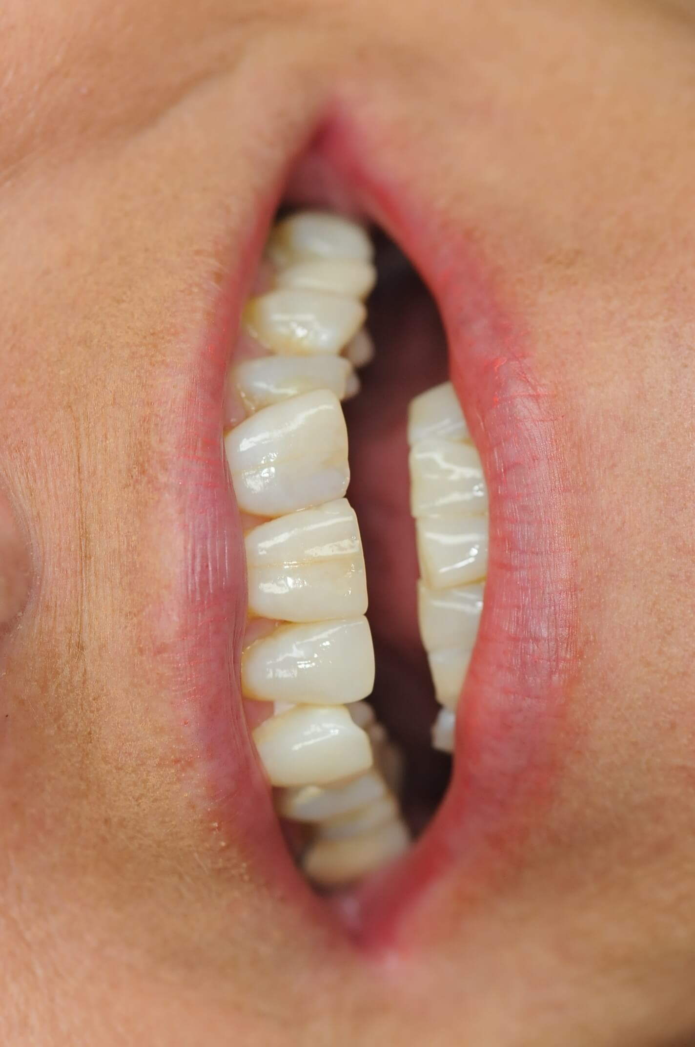 Close up smile Before