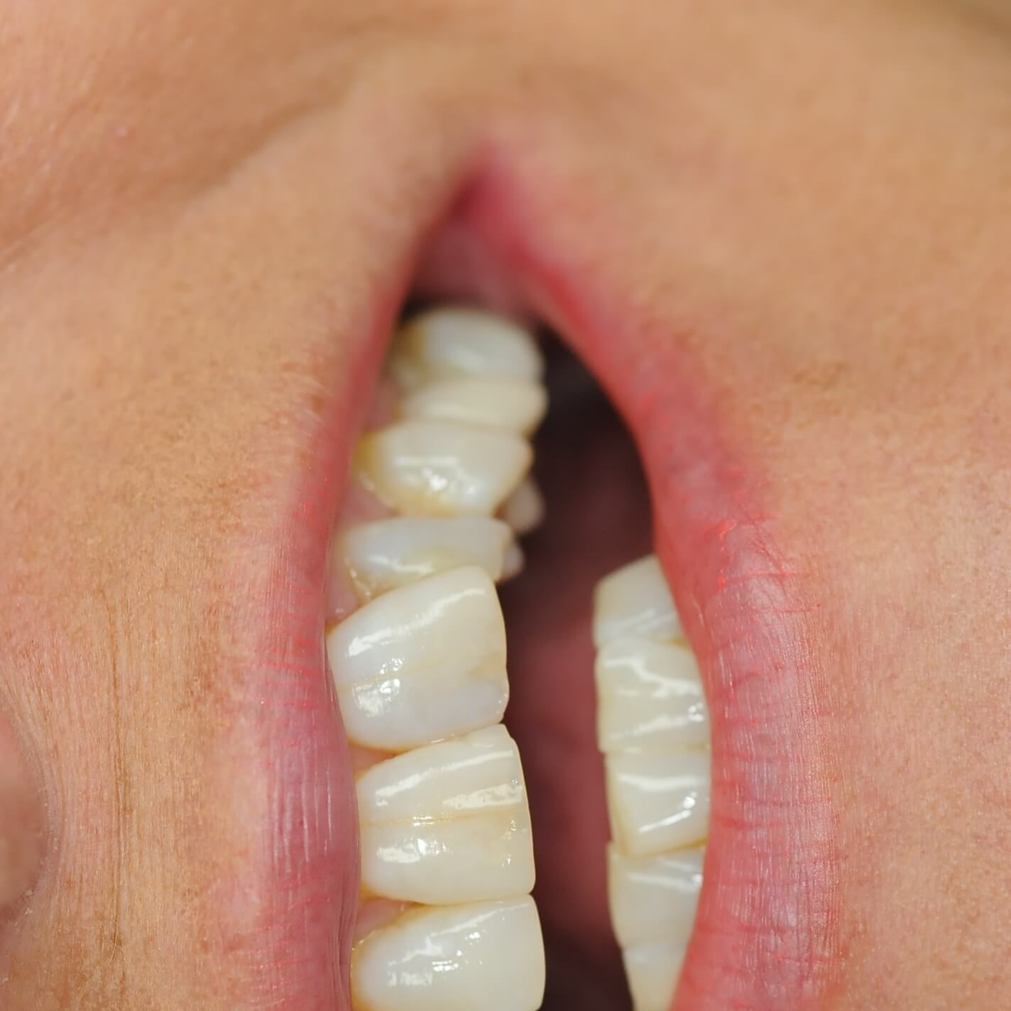 Close up smile Before