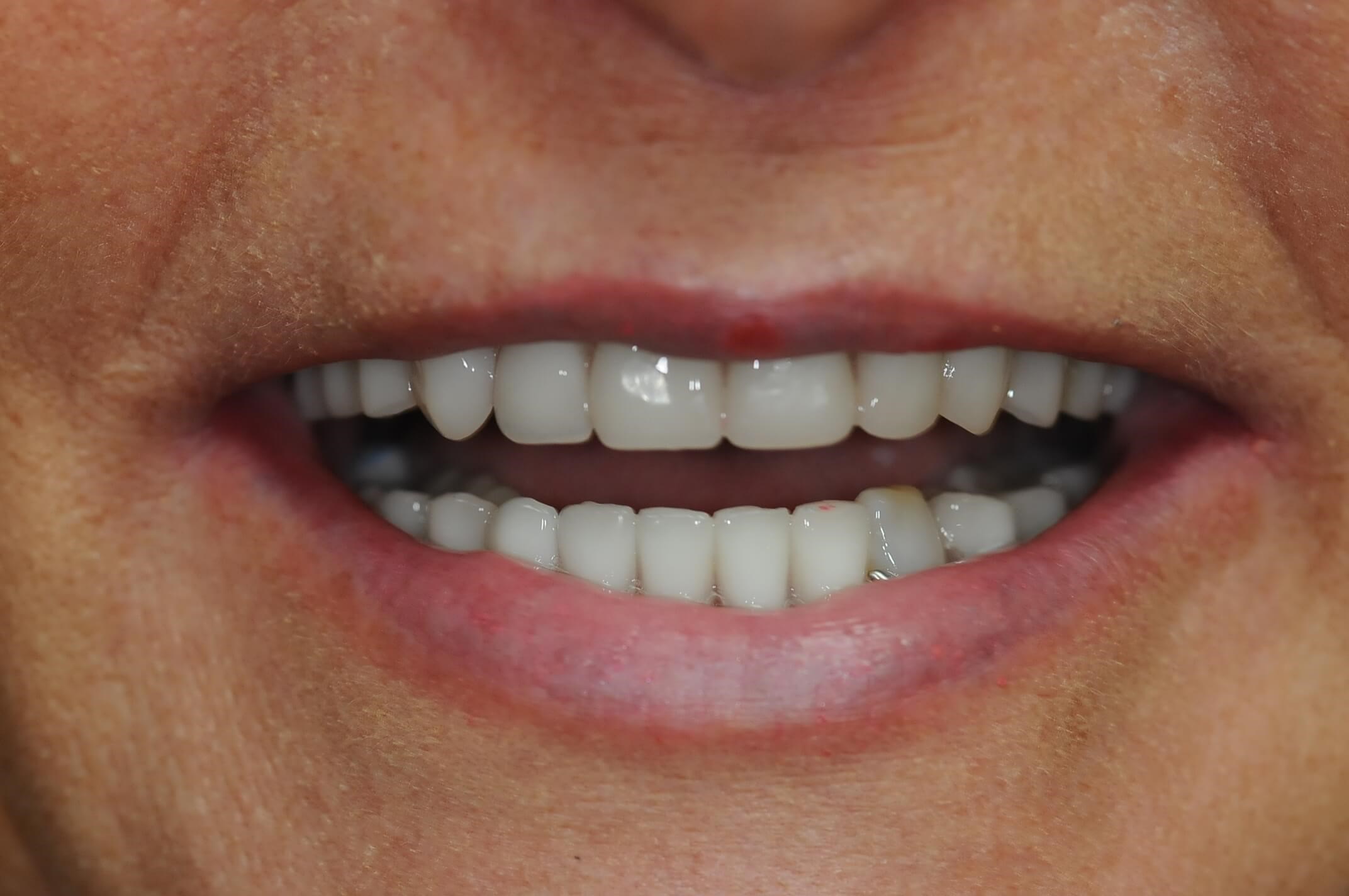 Close up smile 10 days after surgery