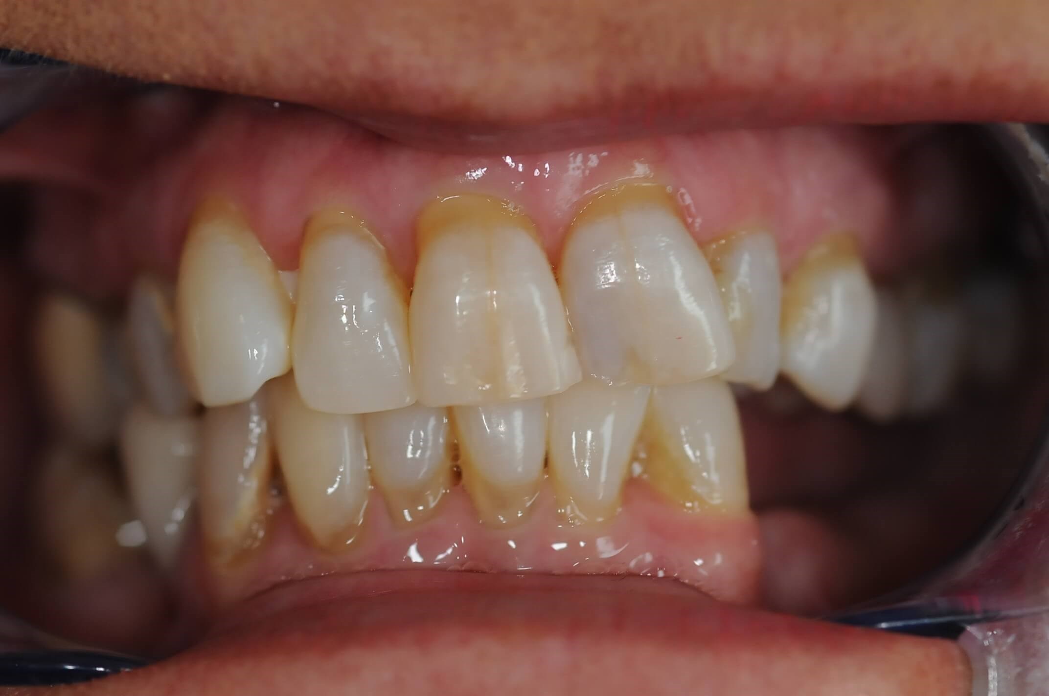 Retracted Smile Before