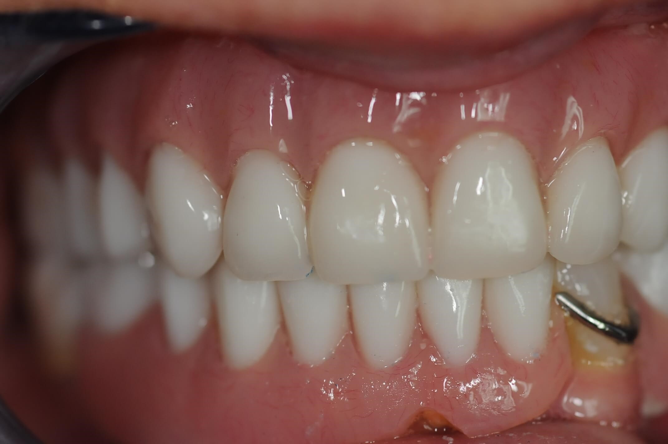 Retracted Smile After
