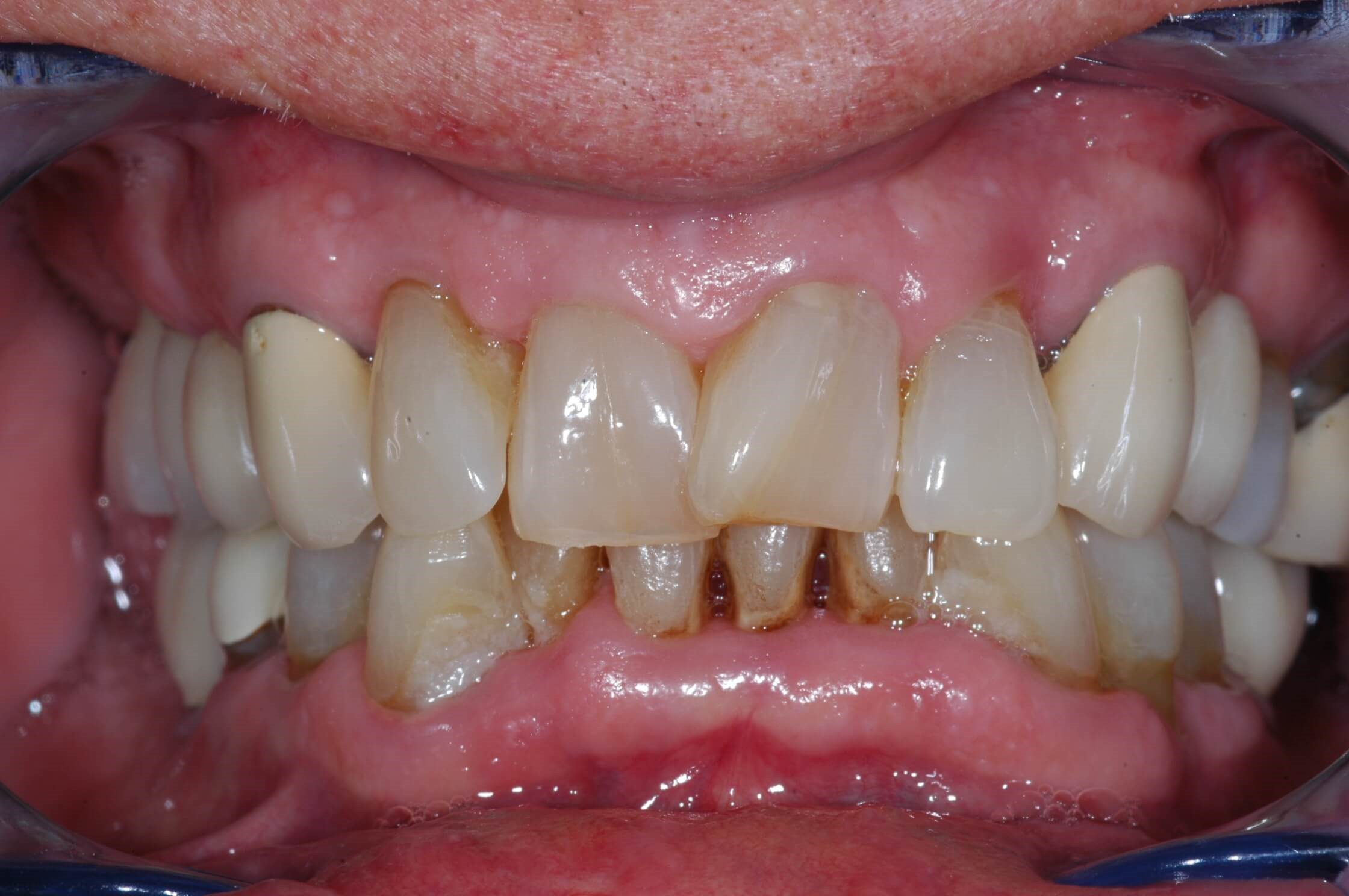 Retracted Smile Before