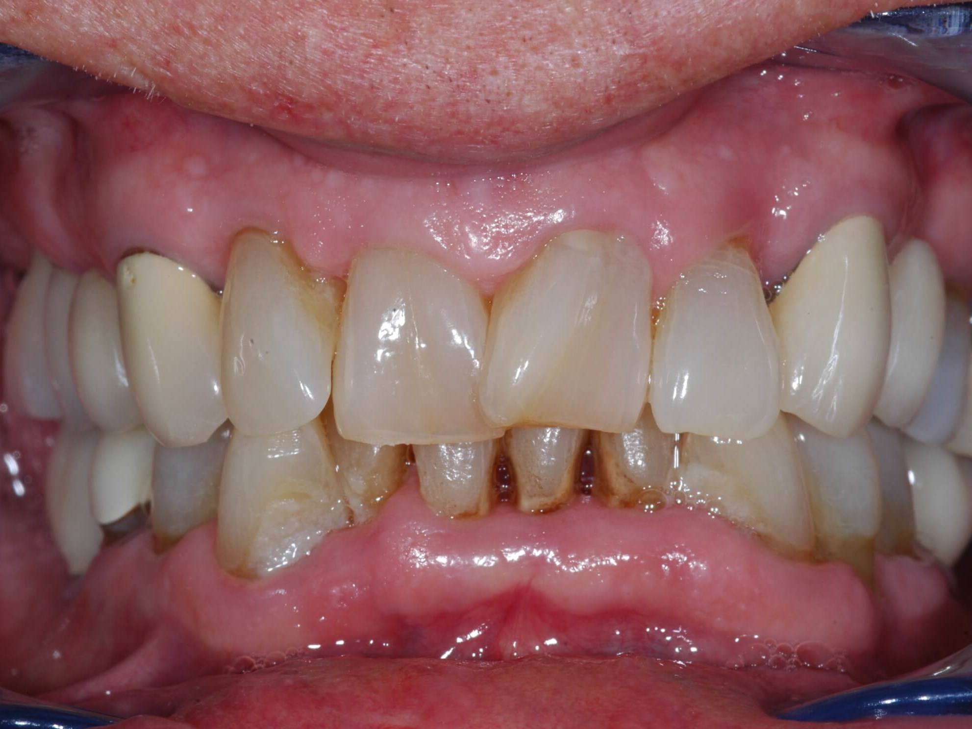 Retracted Smile Before