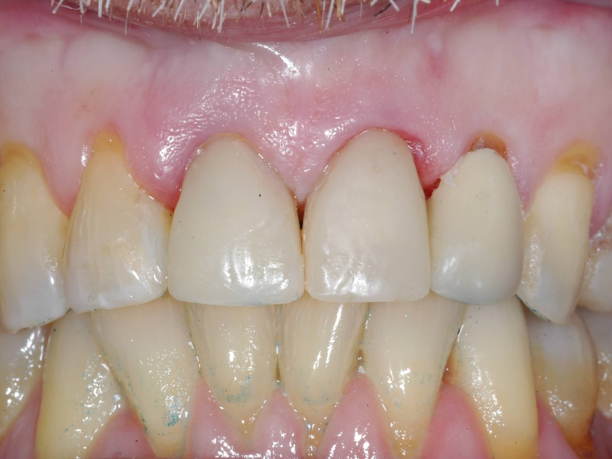 Retracted view Immediately after surgery