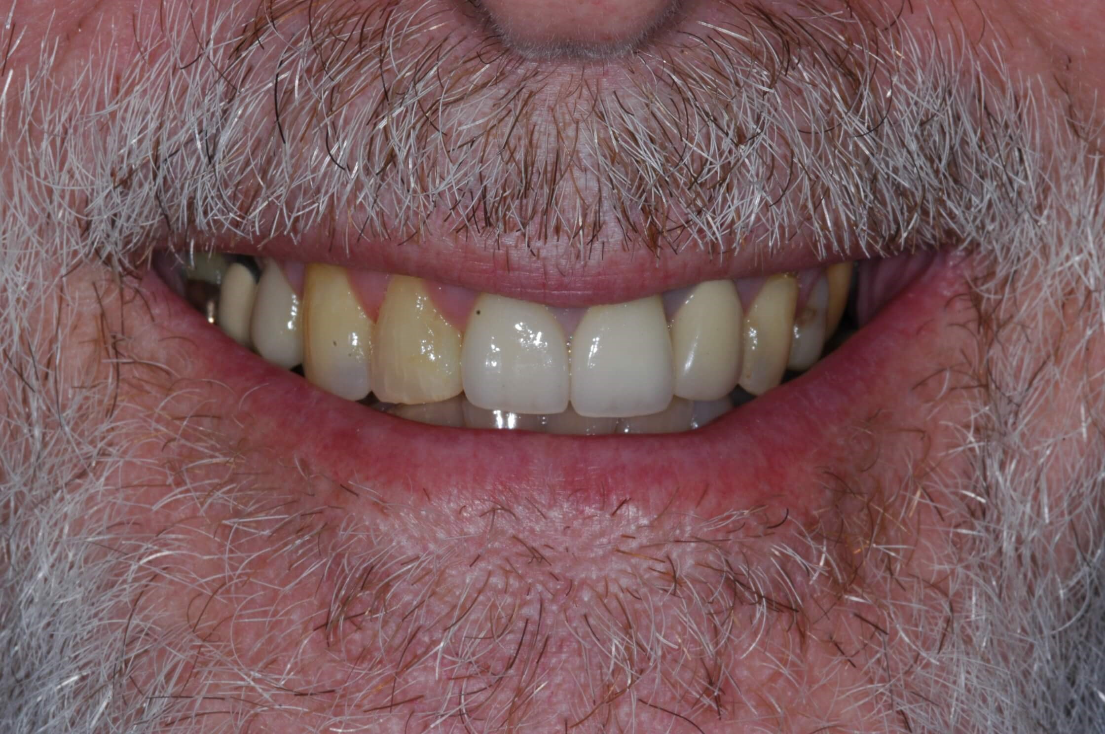 Crowns seated 4 months later Before