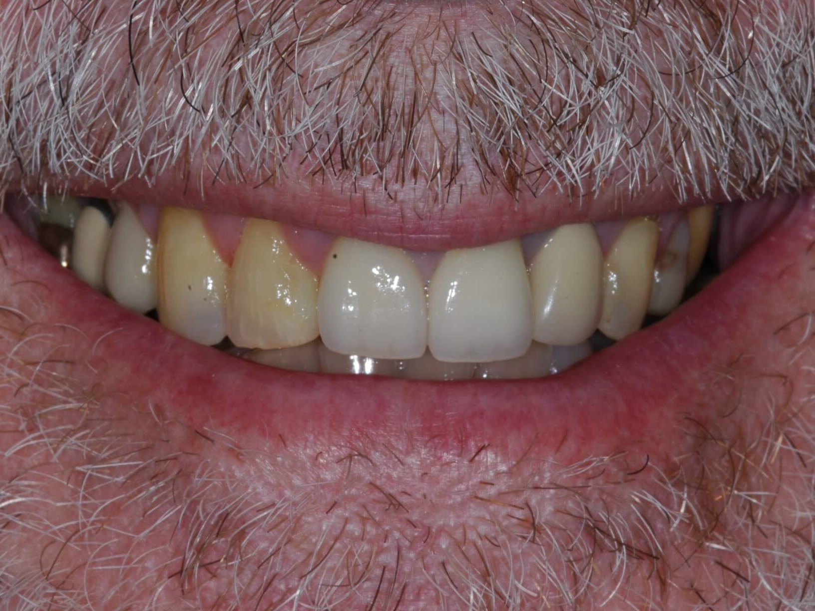 Crowns seated 4 months later Before