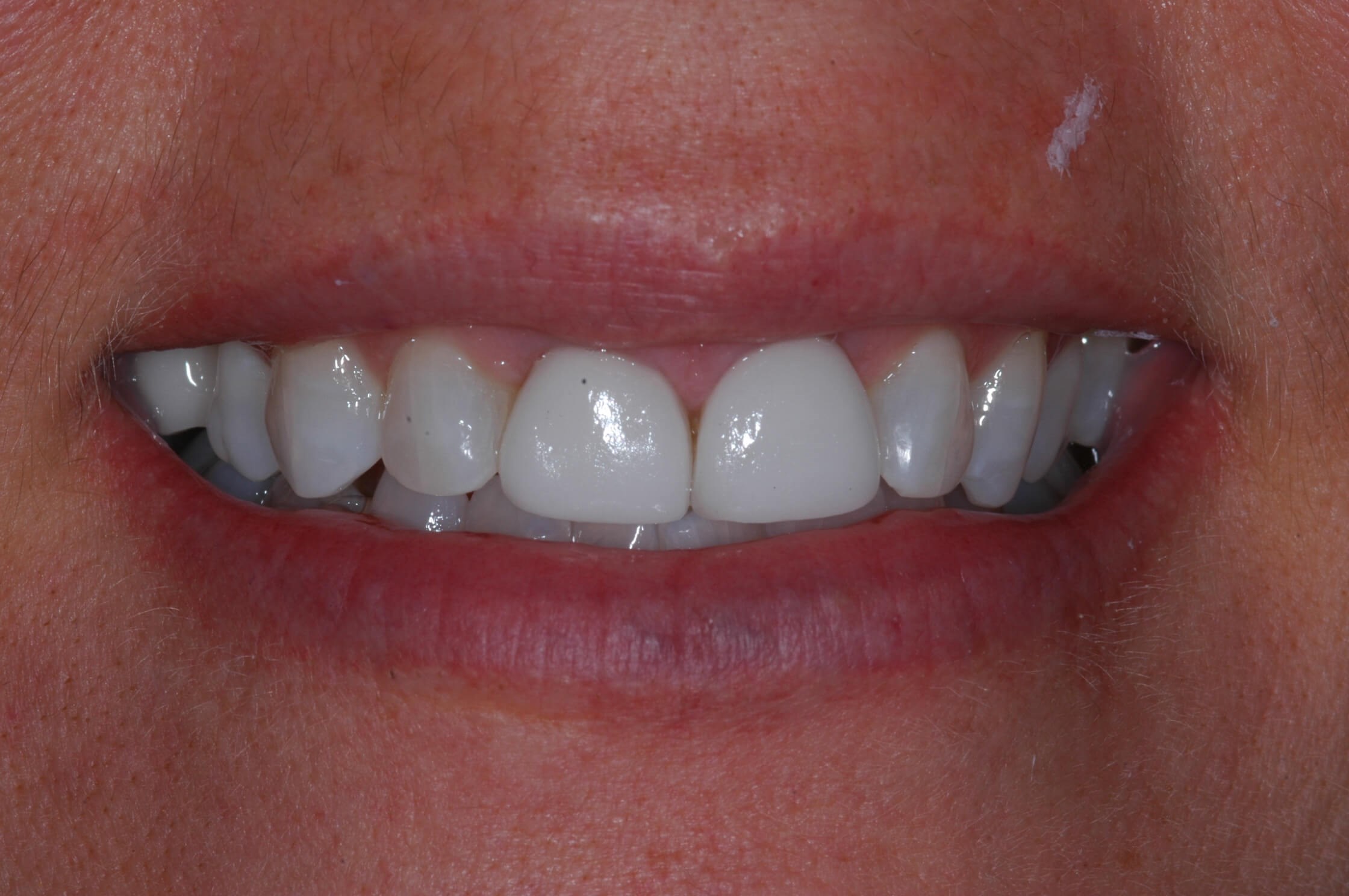 Left front tooth is failing Before -  smiling