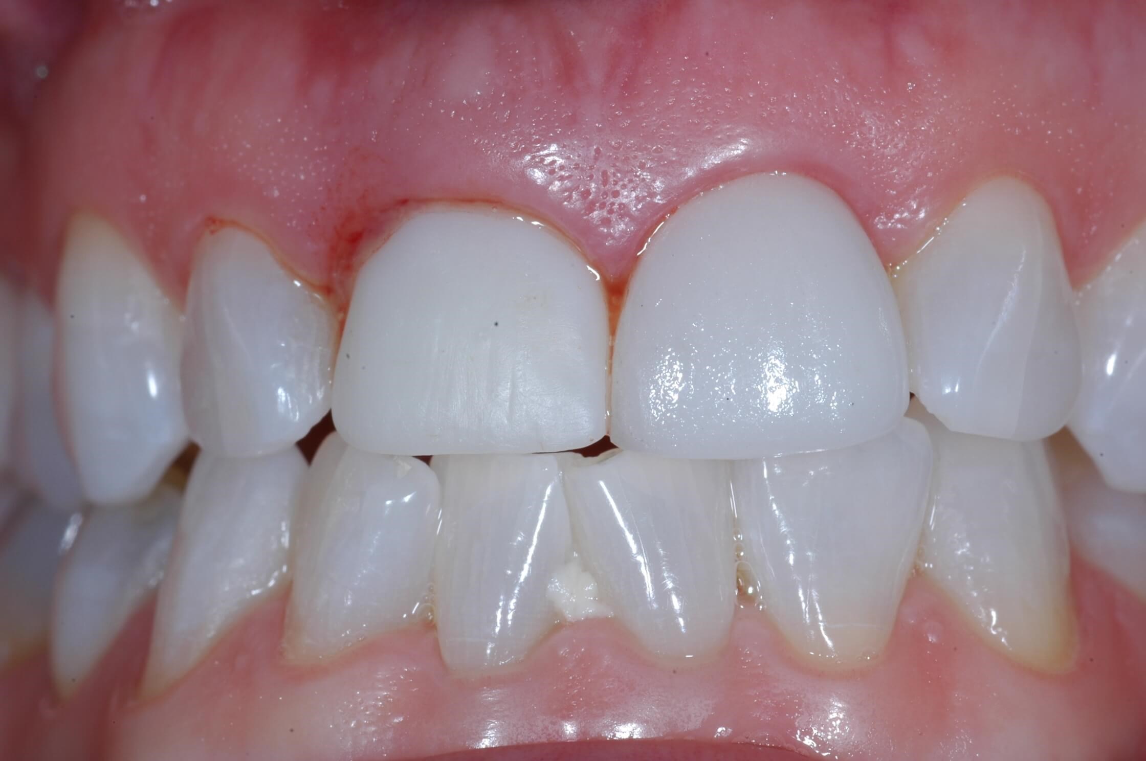 The day of surgery After- temporary crown