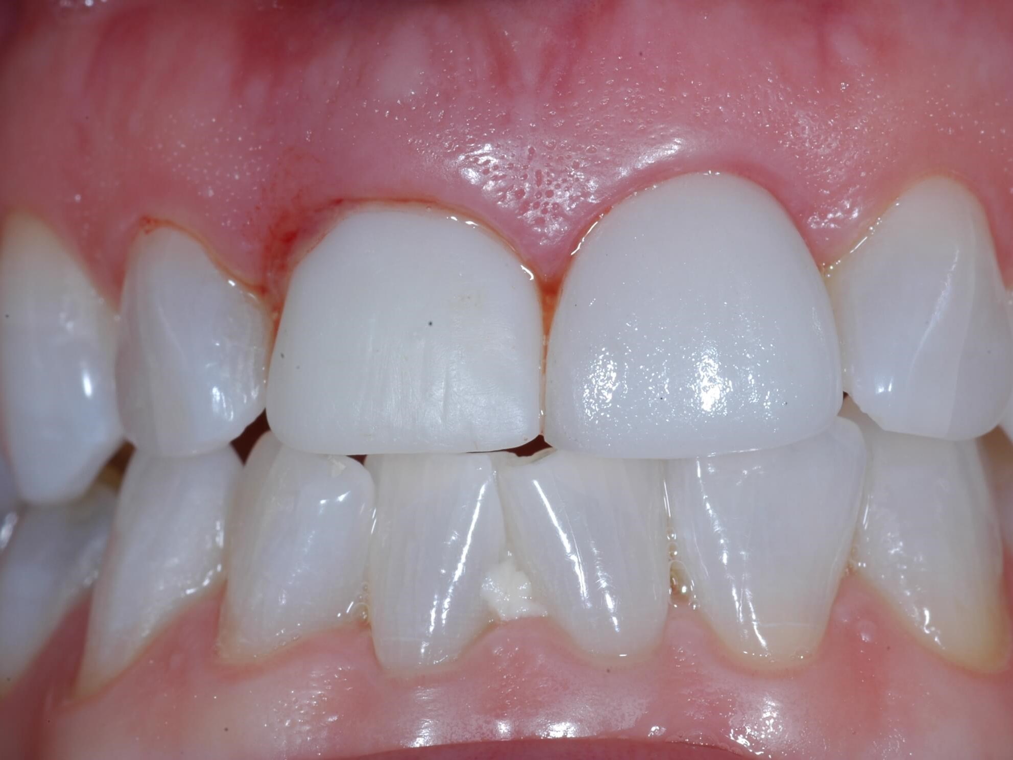 The day of surgery After- temporary crown