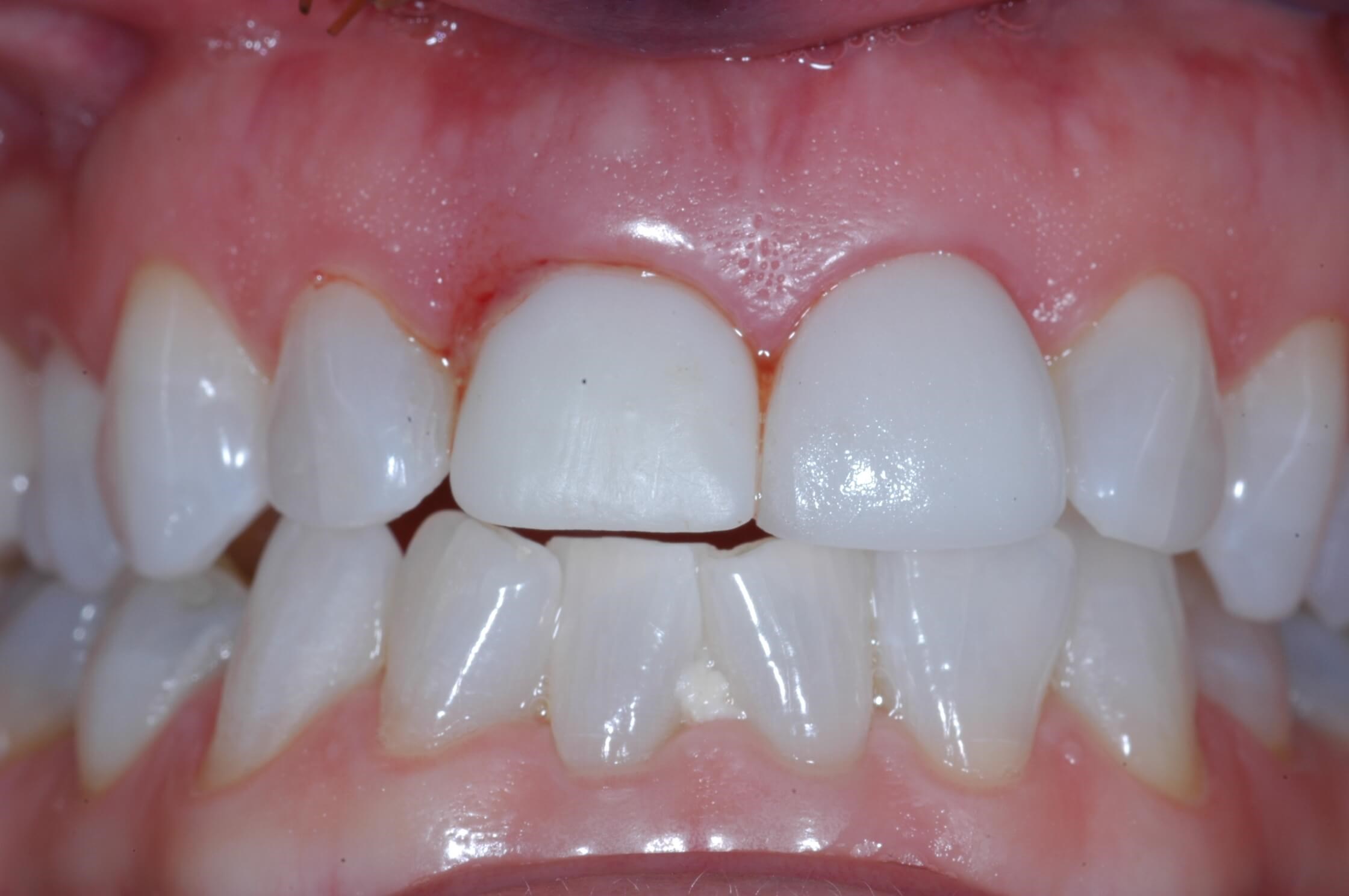 The day of surgery After -view 2 temporay crown