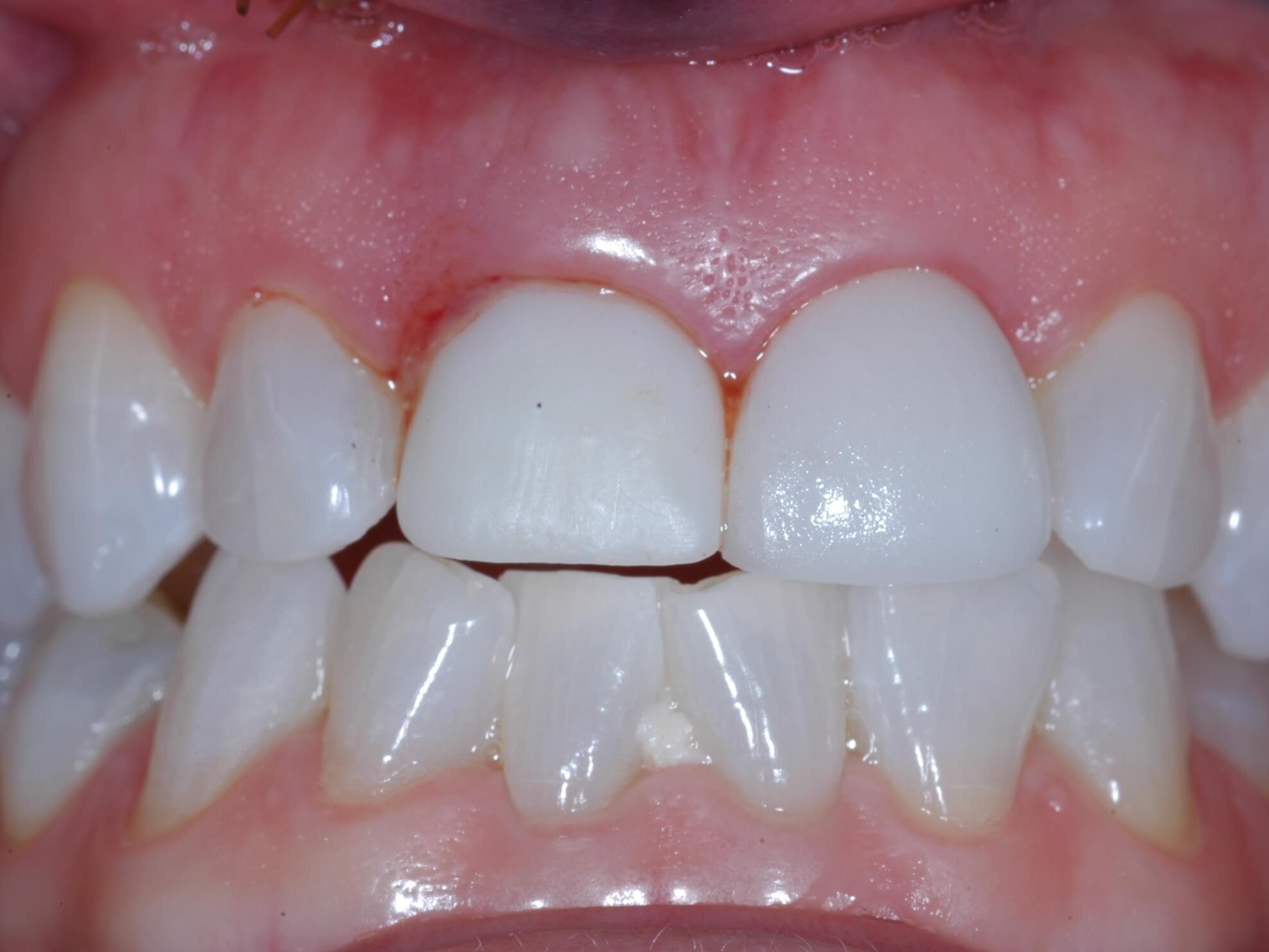 The day of surgery After -view 2 temporay crown