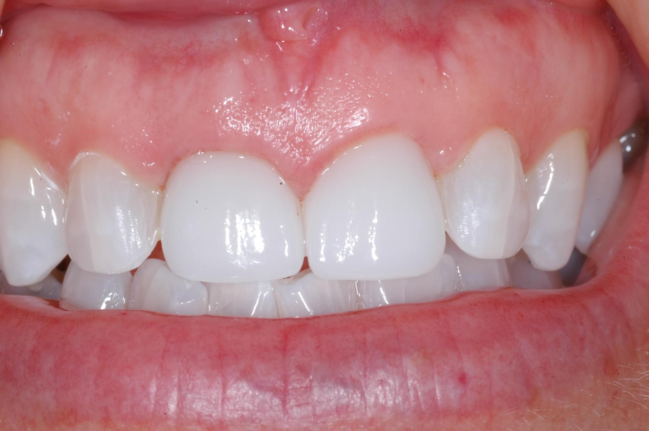 Final - 5 months later After