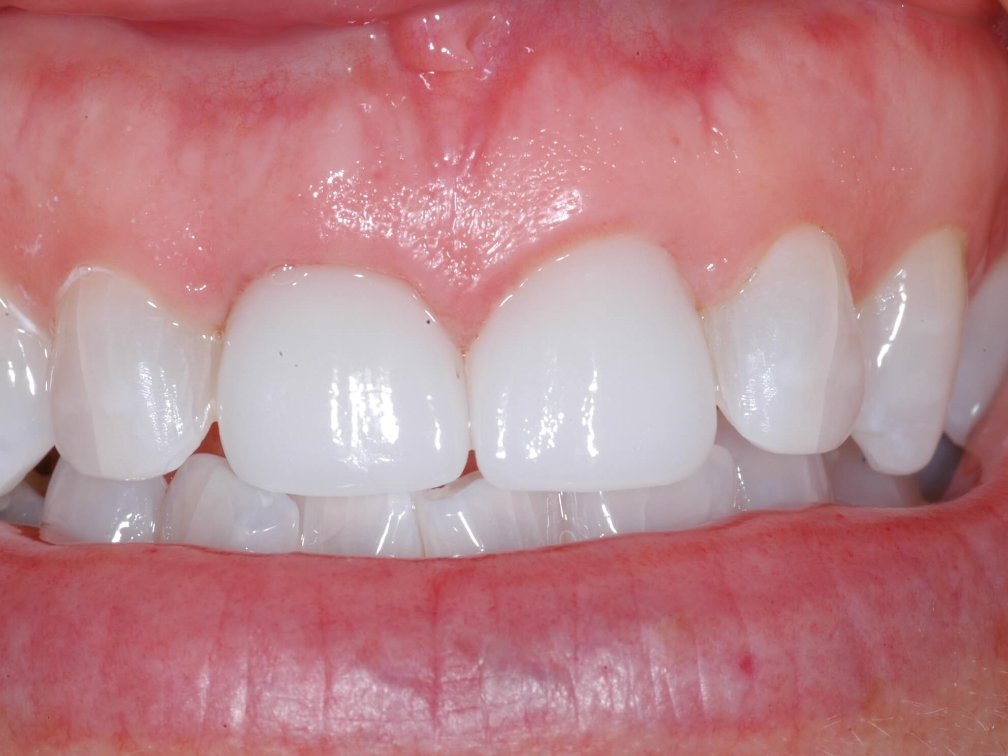 Final - 5 months later After
