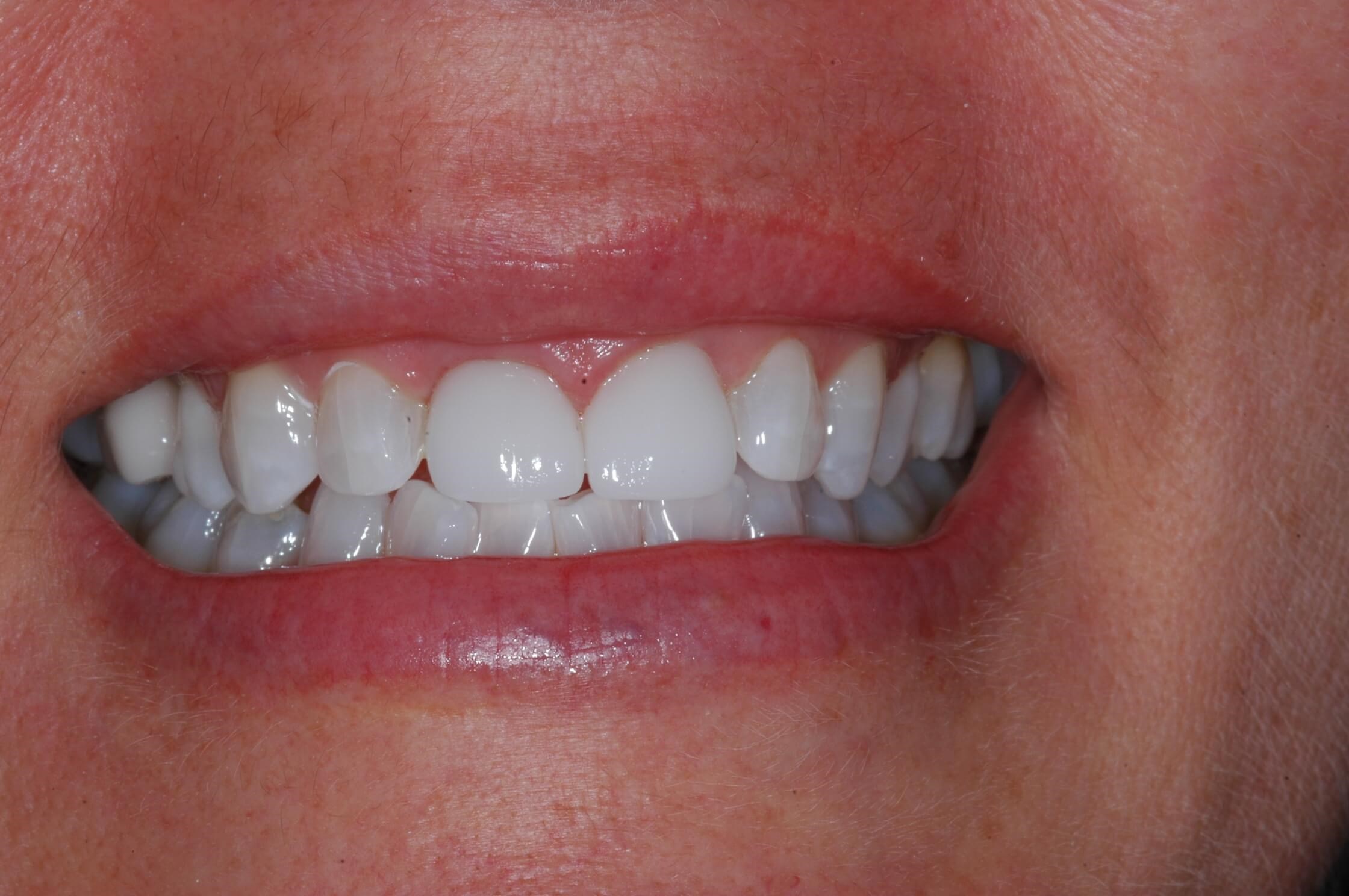 Final - 5 months later After