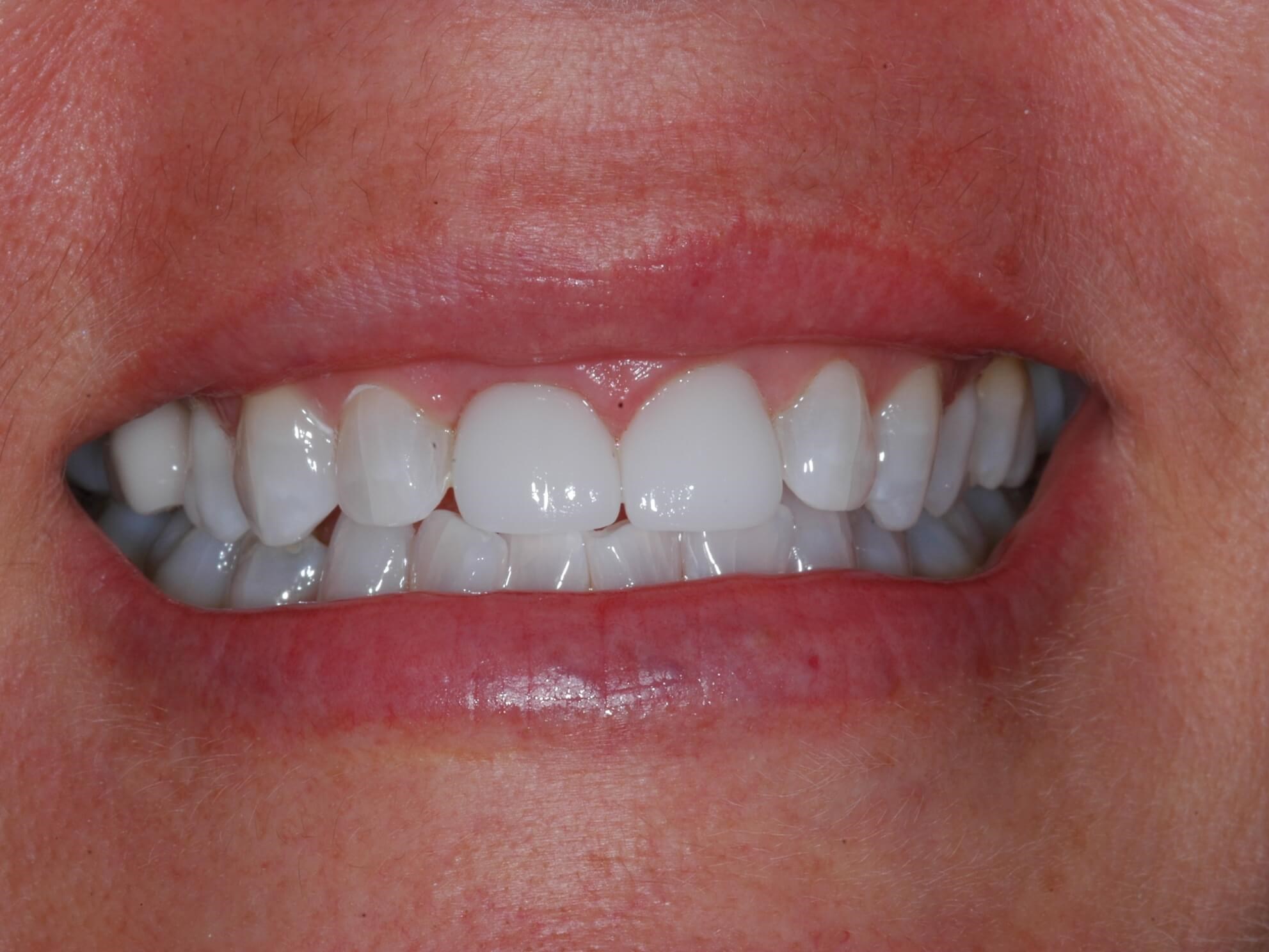Final - 5 months later After