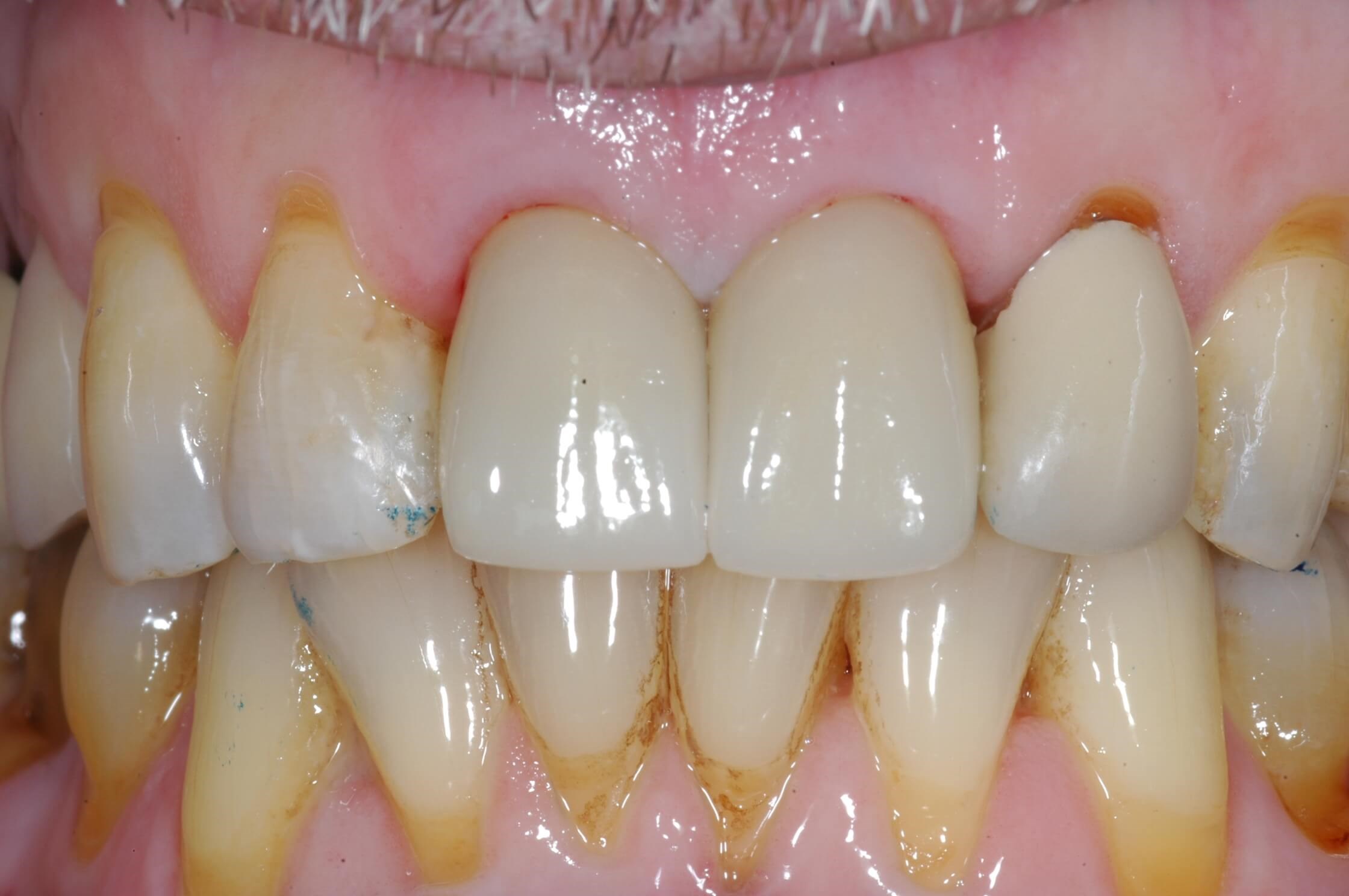 Crowns seated 4 months later After