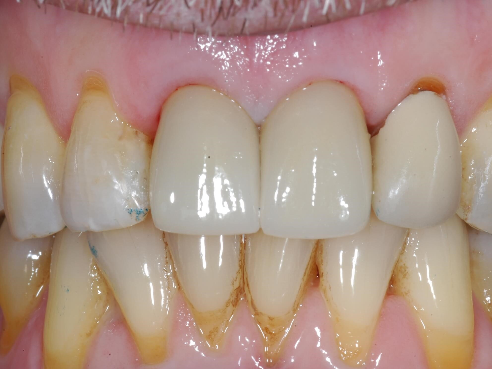 Crowns seated 4 months later After