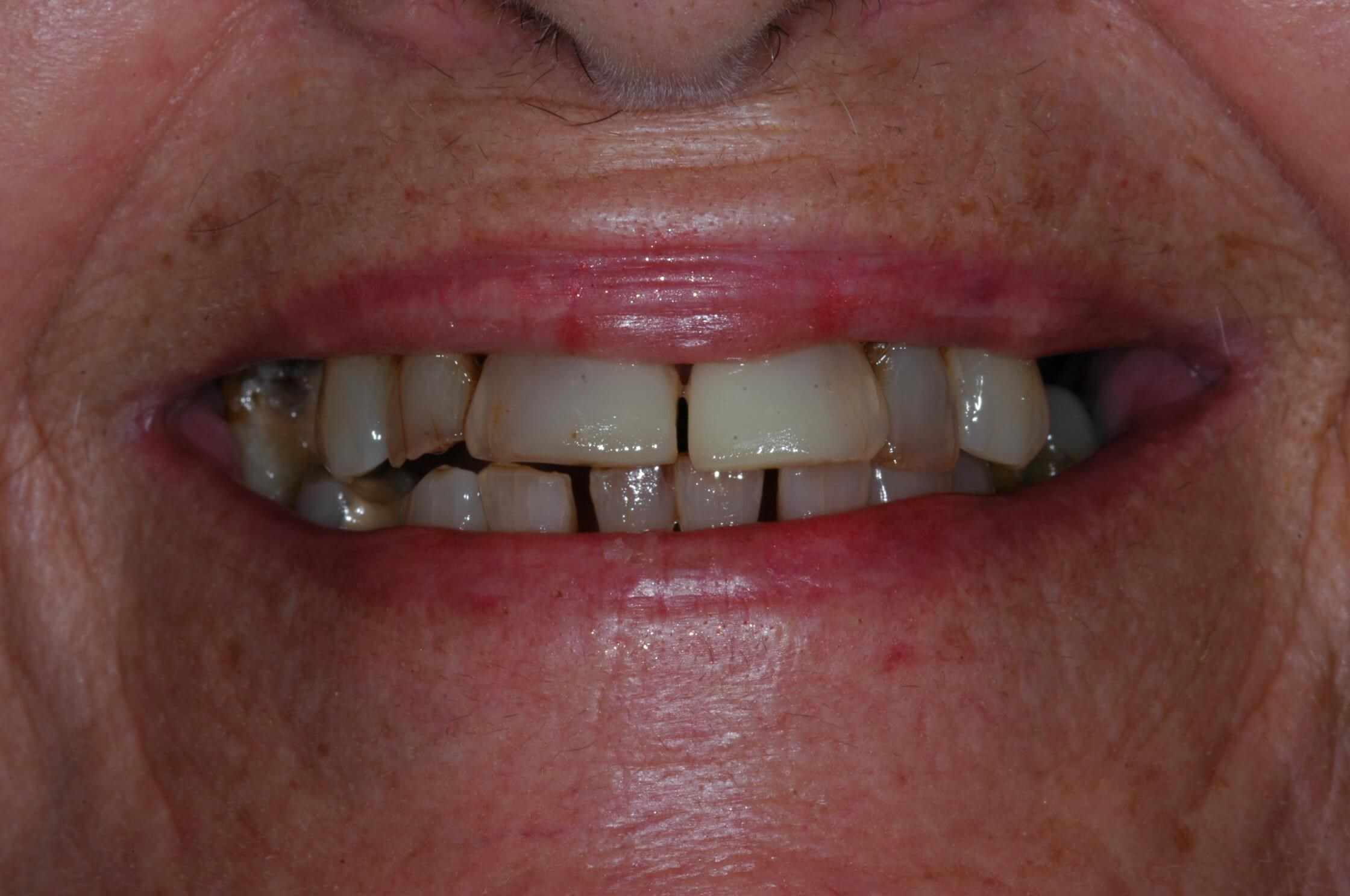 Close-up smiling Before