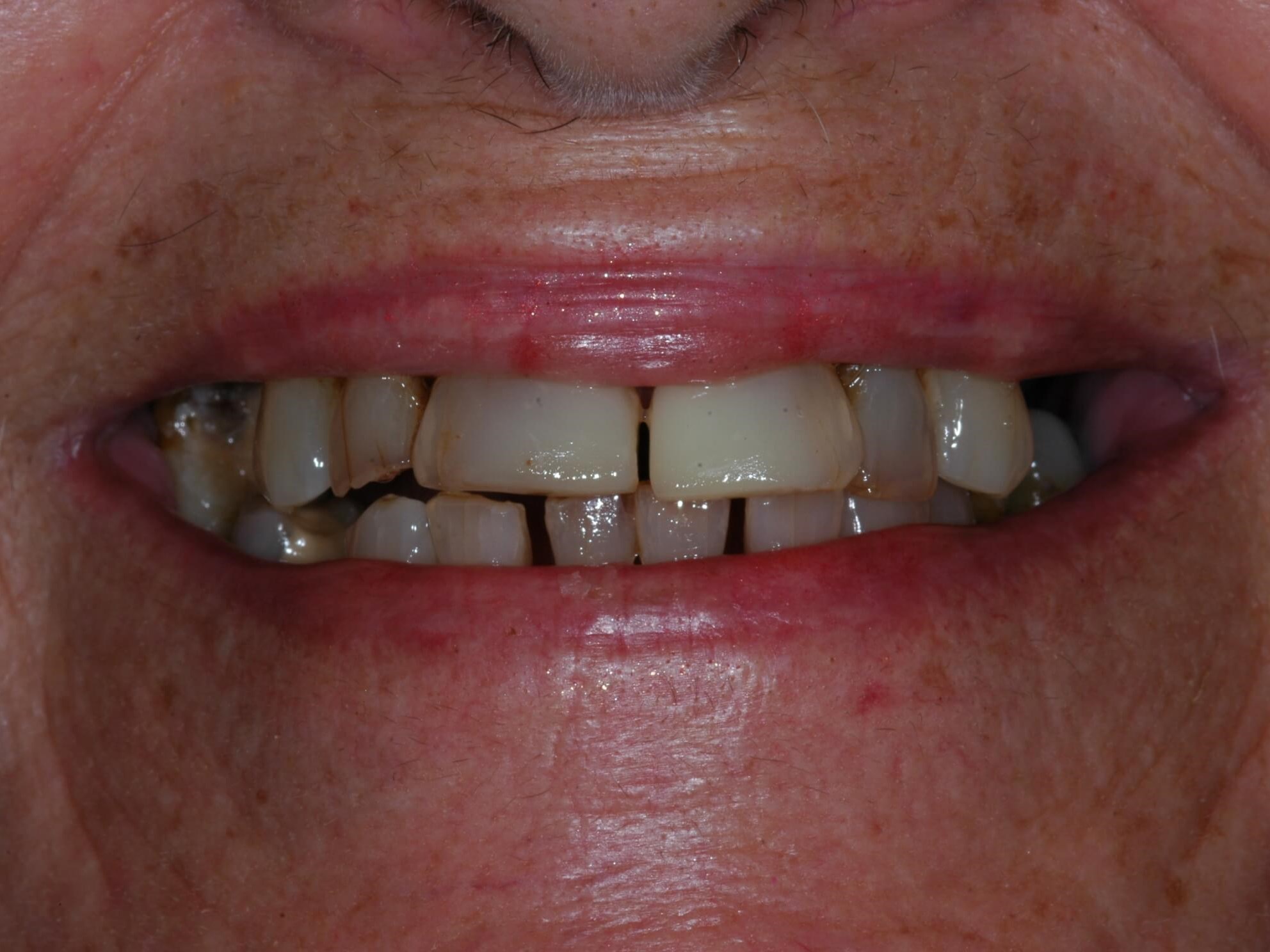 Close-up smiling Before