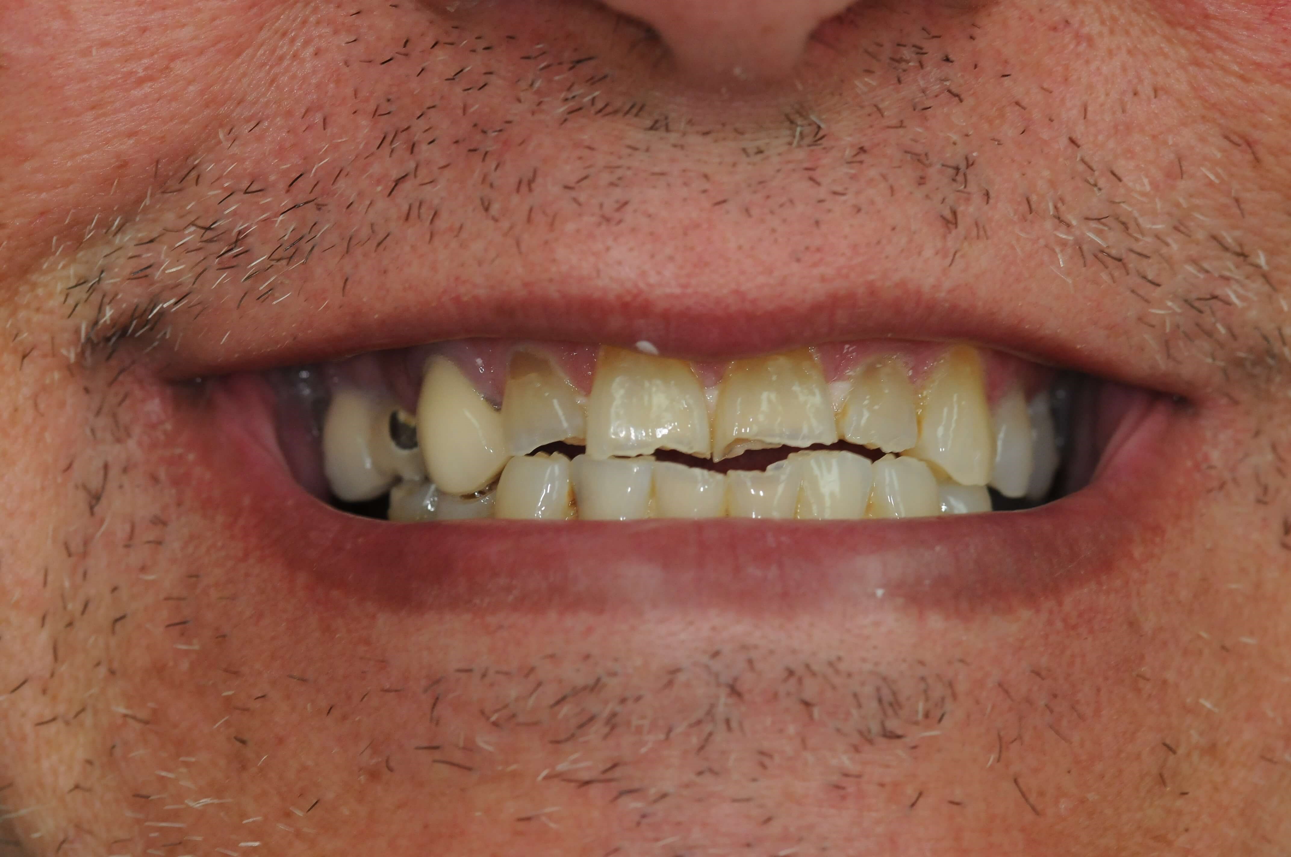 Full Smile Before