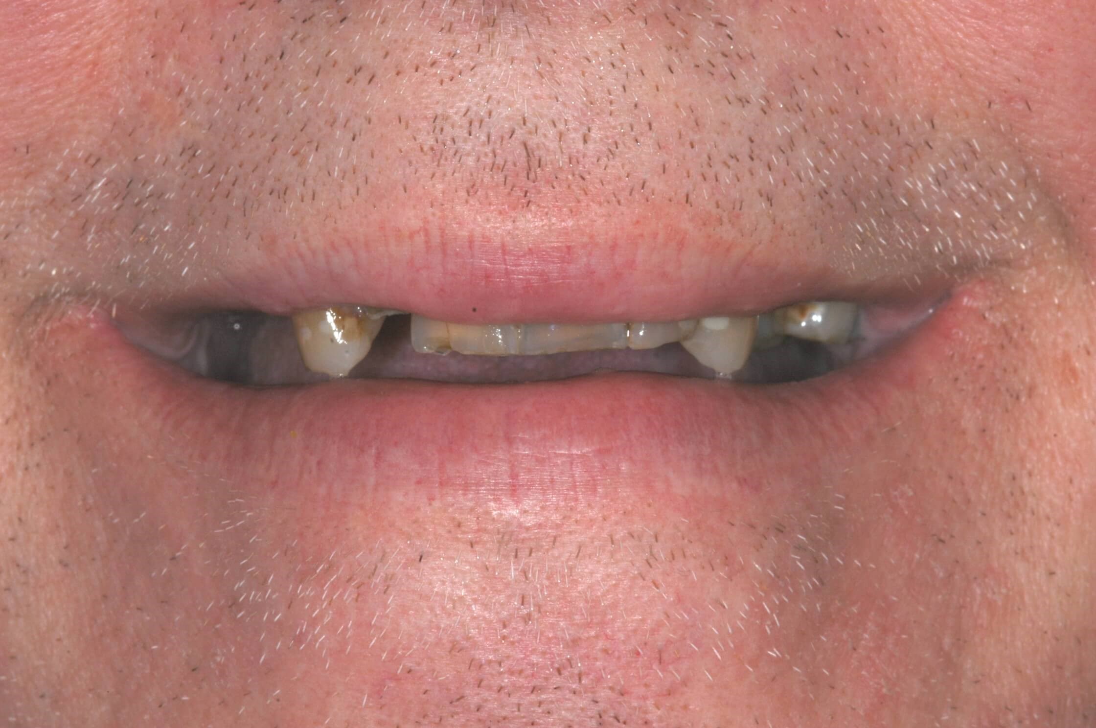 Full Smile Before