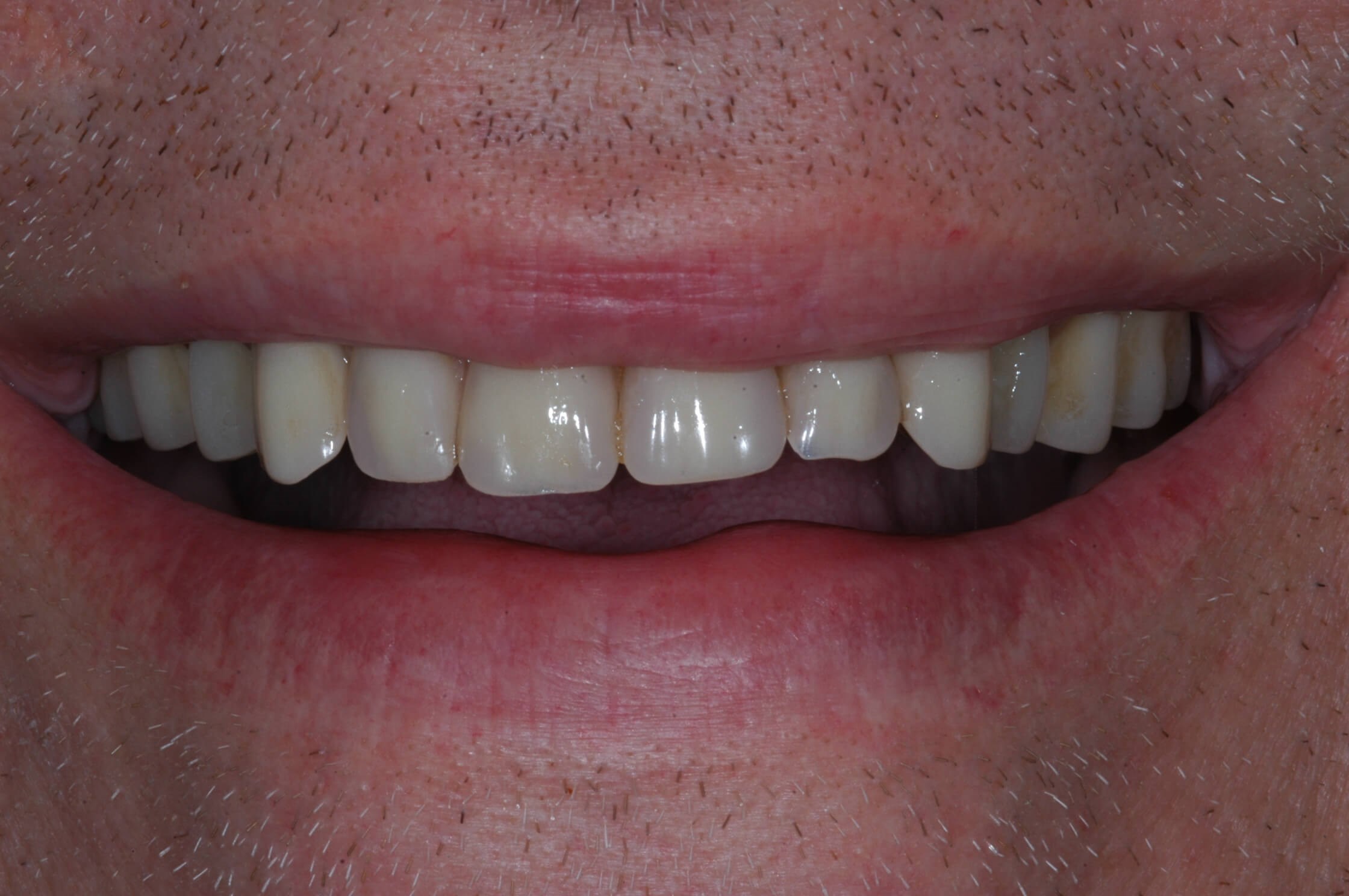 Full Smile After