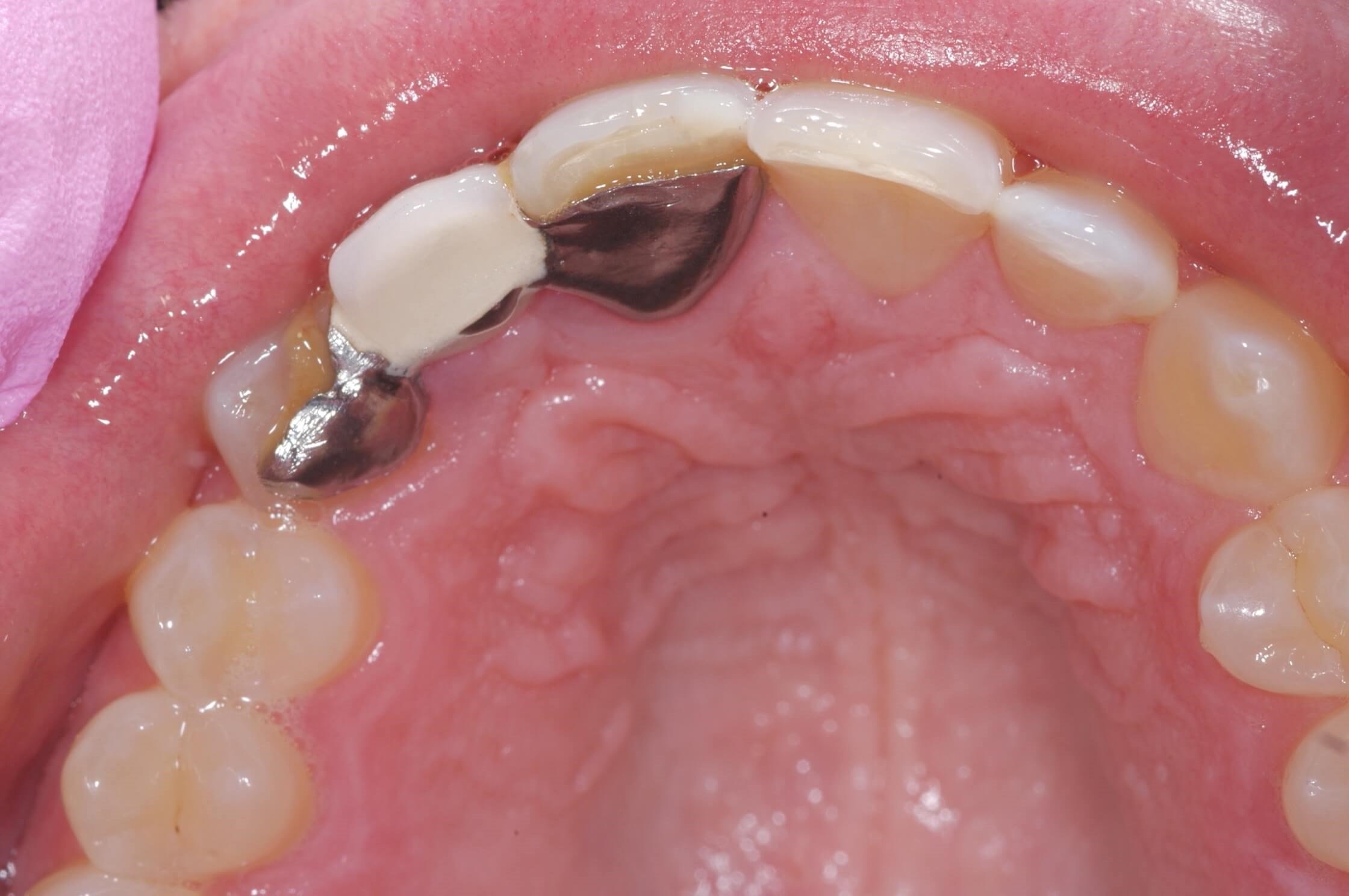 Tongue side view After