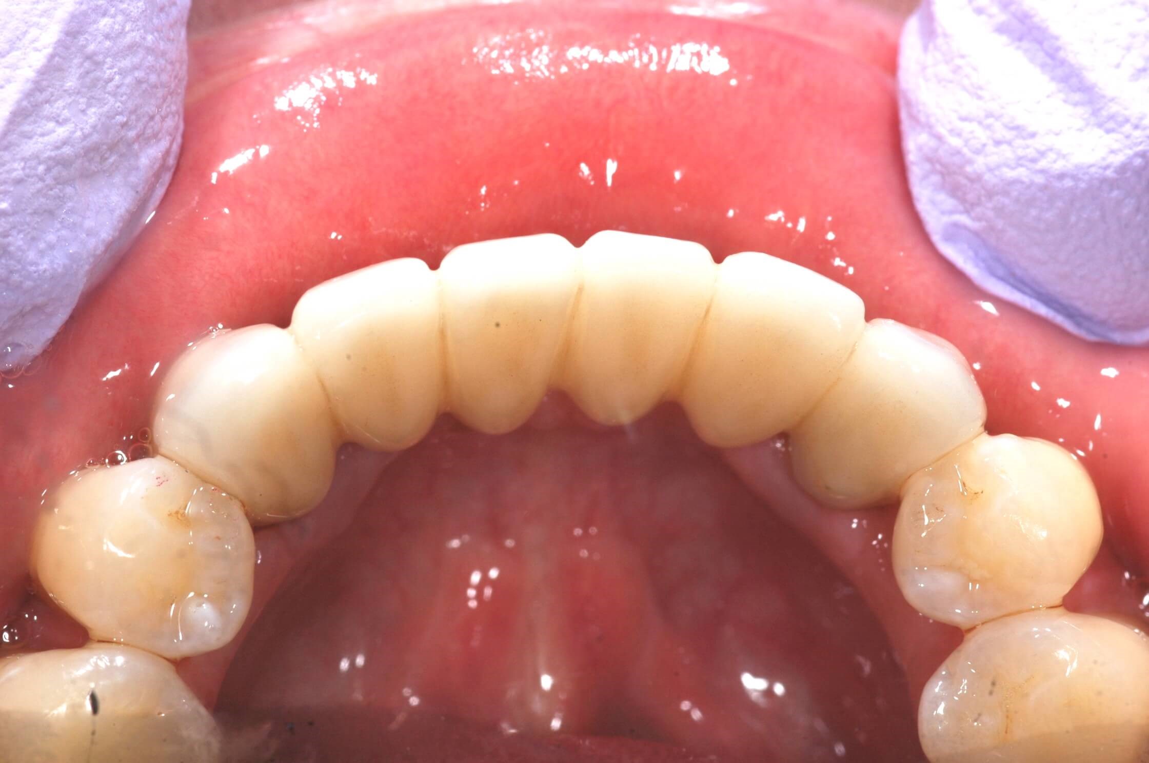 Final bridge After- tongue side view