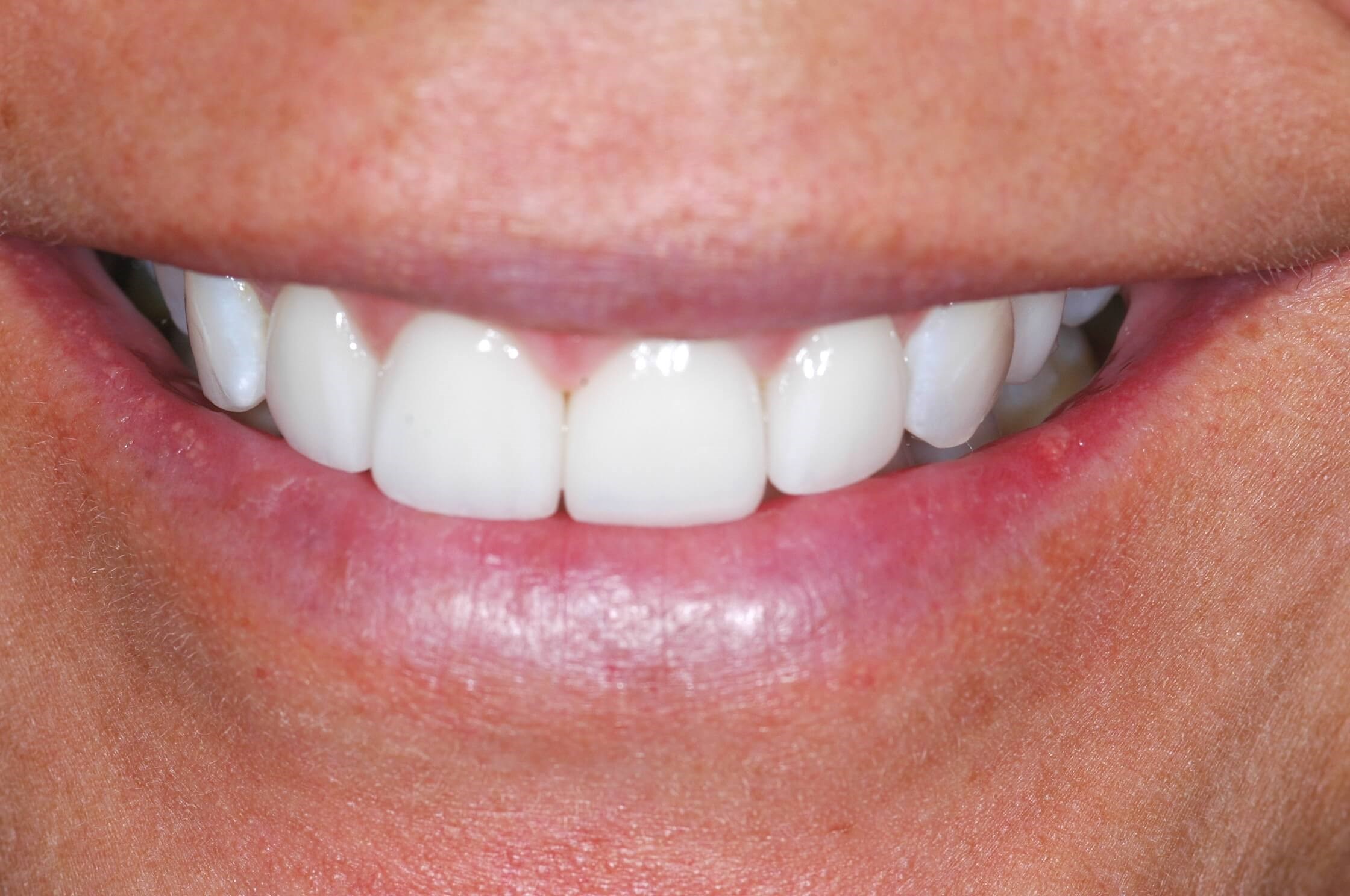 Her Smile After