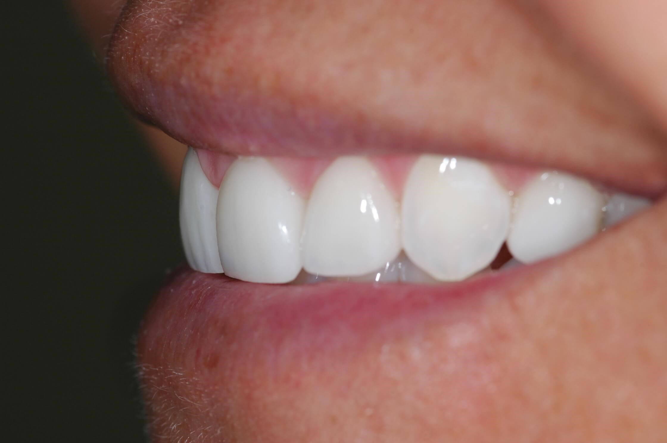 Lateral Views After
