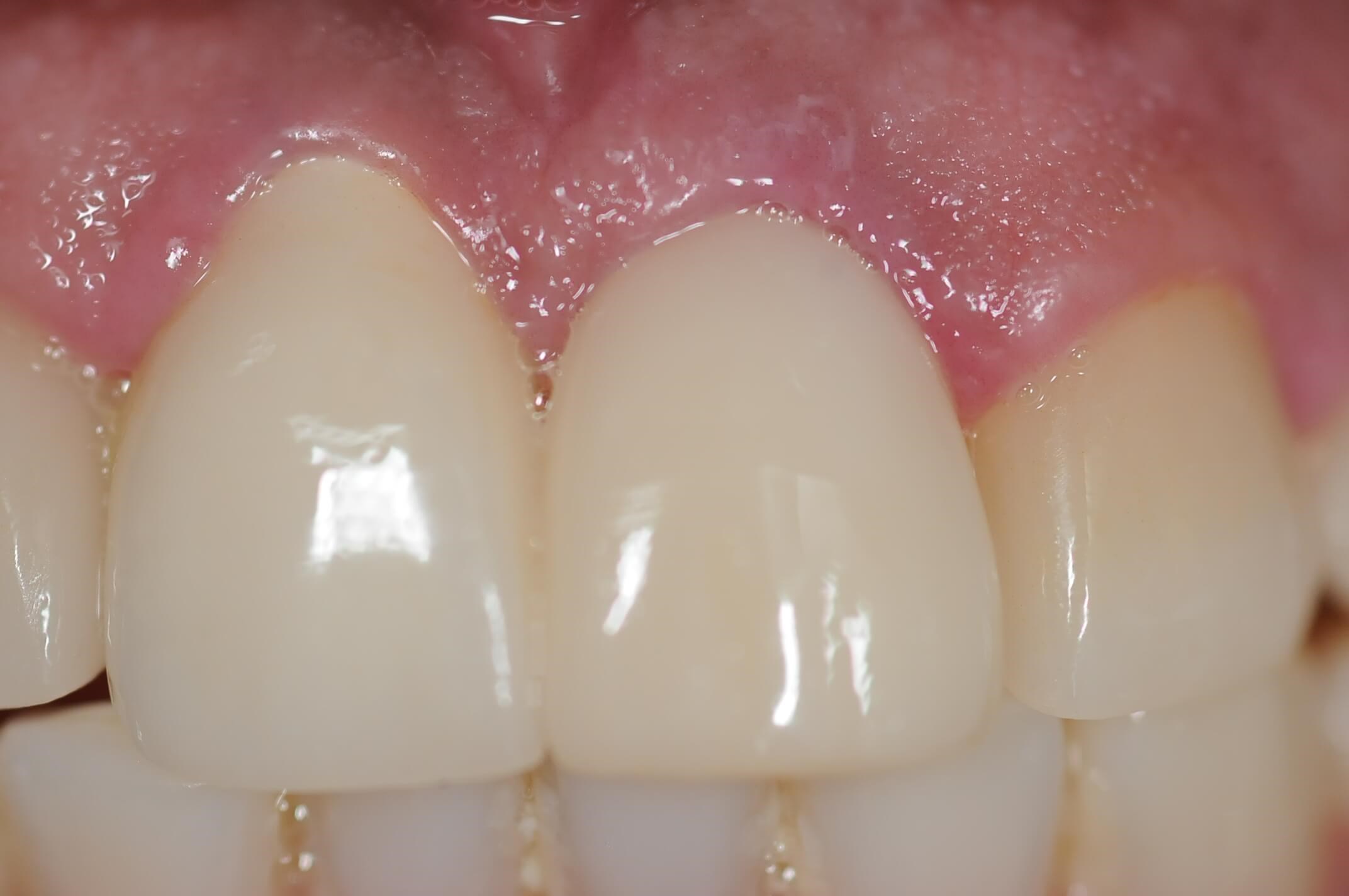 Follow up 5 yrs. later and 2nd  implant
