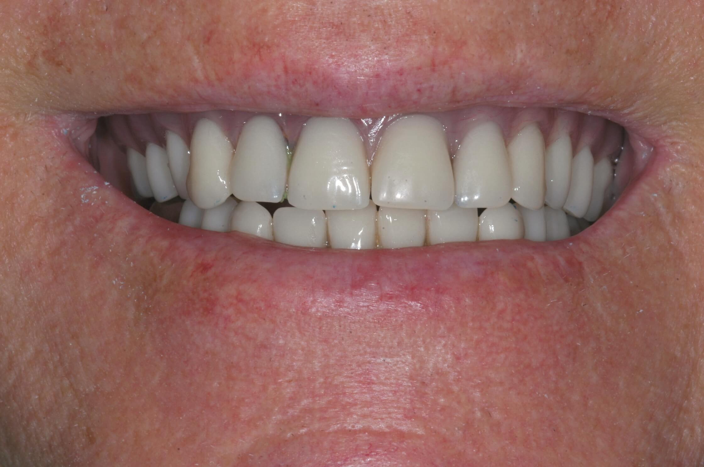 Retracted Smile 10 days after surgery