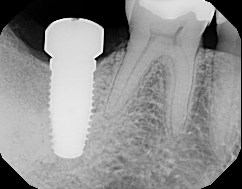 Implant placed Correct Implant size