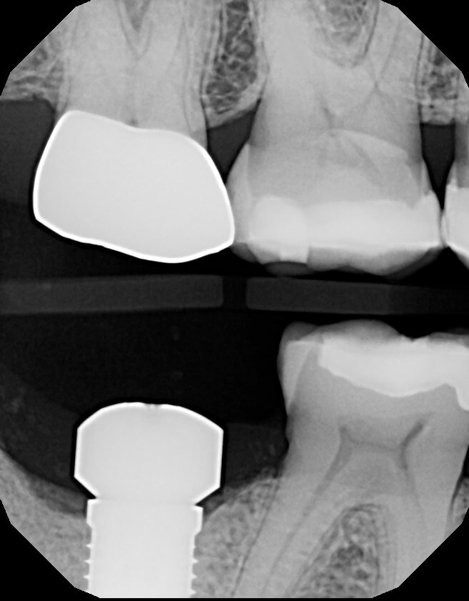 Implant placed Correct position