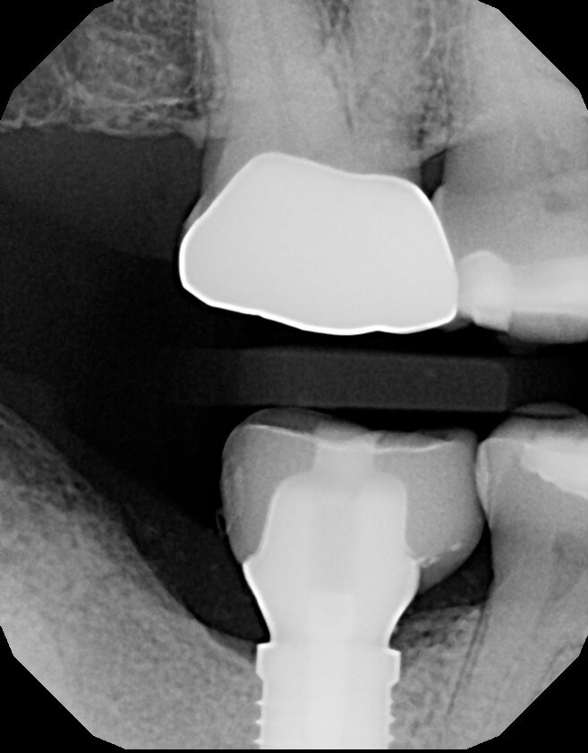 Custom abutment and crown Final